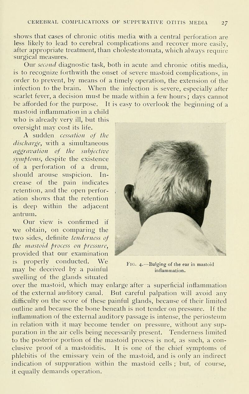 shows that cases of chronic otitis media with a central perforation are less likely to lead to cerebral complications and recover more easily, after appropriate treatment, than cholesteatomata, which always require surgical measures. Ouv stxond diagnostic task, both in acute and chronic otitis media, is to recognize forthwith the onset of severe mastoid complications, in order to prevent, by means of a timely operation, the extension of the infection to the brain. When the infection is severe, especially after scarlet fever, a decision must be made within a few hours; days cannot be afforded for the purpose. It is easy to overlook the beginning of a mastoid inflammation in a child who is already very ill, but this oversight may cost its life, A sudden cessation of tJie disdiarge, with a simultaneous aggravation of the snbjcctivc symptoms, despite the existence of a perforation of a drum, should arouse suspicion. In- crease of the pain indicates retention, and the open perfor- ation shows that the retention is deep within the adjacent antrum. Our view is confirmed if we obtain, on comparing the two sides, definite tenderness of the mastoid process on pressure, provided that our examination is properly conducted. We may be deceived by a painful swelling of the glands situated over the mastoid, which may enlarge after a superficial inflammation of the external auditory canal. But careful palpation will avoid any difSculty on the score of these painful glands, because of their limited outline and because the bone beneath is not tender on pressure. If the inflammation of the external auditory passage is intense, the periosteum in relation with it may become tender on pressure, without any sup- puration in the air cells being necessarily present. Tenderness limited to the posterior portion of the mastoid process is not, as such, a con- clusive proof of a mastoiditis. It is one of the chief symptoms of phlebitis of the emissary vein of the mastoid, and is only an indirect indication of suppuration within the mastoid cells ; but, of course, it equally demands operation. Fig. 4. -Bulging of the ear in mastoid inflammation.