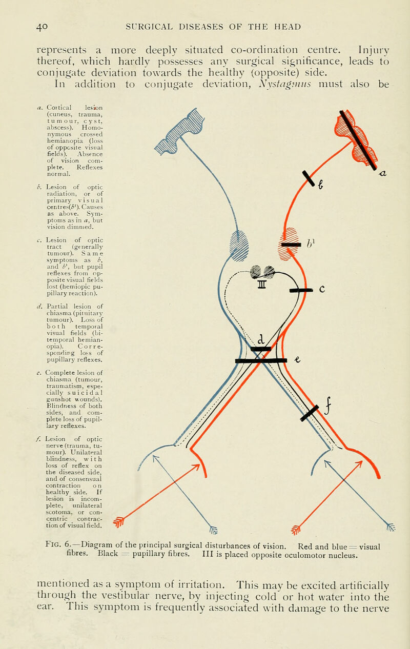 represents a more deeply situated co-ordination centre. Injury thereof, which hardly possesses any surgical significance, leads to conjugate deviation towards the healthy (opposite) side. In addition to conjugate deviation, S'ystng^iiiis must also be a. Cortical lesion (cuneus, trauma, tumour, cyst, abscess). Homo- nymous crossed hemiatiopia (loss of opposite visual fields). Absence of vision com- plete. Reflexes normal. i. Lesion of optic radiation, or of primary visual centres(i5'). Causes as above. Sym- ptoms as in a, but vision dimmed. <r. Lesion of optic tract (generally tumour). Same symptoms as i, and d', but pupil reflexes from op- posite visual fields lost (hemiopic pu- pillary reaction). (/. Partial lesion of chiasma (pituitary tumour). Loss of both temporal visual fields (bi- temporal bemian- opia). C o r r e- sponding loss of pupillary reflexes. c. Complete lesion of chiasma (tumour, traumatism, espe- cially suicidal jjunshot wounds). Blindness of both sides, and com- plete loss of pupil- lary reflexes. /. Lesion of optic nerve (trauma, tu- mour). Unilateral blindness, with loss of reflex on the diseased side, and of consensual contraction on healthy side. If lesion is incom- plete, unilateral scotoma, or con- centric contrac- tion of visual field. Fig. 6.—Diagram of the principal surgical disturbances of vision. Red and blue = visual fibres. Black = pupillary fibres. Ill is placed opposite oculomotor nucleus. mentioned as a symptom of irritation. This may be excited artificially through the vestibular nerve, by injecting cold or hot water into the ear. This symptom is frequently associated with damage to the nerve