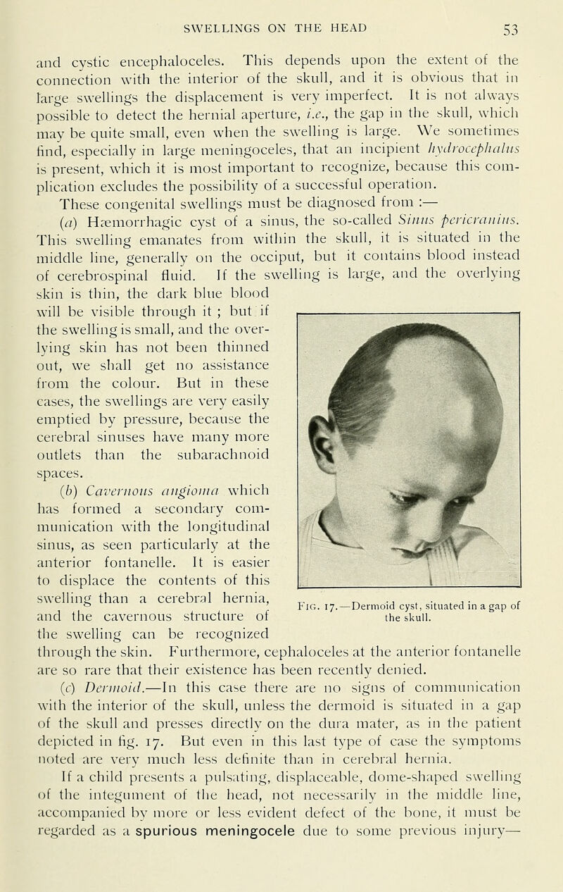 and cystic encephaloceles. This depends upon the extent of the connection with the interior of the skull, and it is obvious that in large swellings the displacement is very imperfect. It is not always possible to detect the hernial aperture, i.e., the gap in the skull, which may be quite small, even when the swelling is large. We sometimes find, especially in large meningoceles, that an incipient liydroccphahis is present, which it is most important to recognize, because this com- plication excludes the possibility of a successful operation. These congenital swellings must be diagnosed from :— (a) H^emorrhagic cyst of a sinus, the so-called Siiiiis pericmiiiiis. This swelling emanates from within the skull, it is situated in the middle line, generally on the occiput, but it contains blood instead of cerebrospinal fluid. If the swelling is large, and the overlying skin is thin, the dark blue blood will be visible through it ; but if the swelling is small, and the over- lying skin has not been thinned out, we shall get no assistance from the colour. But in these cases, the swellings are very easily emptied by pressure, because the cerebral sinuses have many more outlets than the subarachnoid spaces. (6) Cavernous angioma which has formed a secondary com- munication with the longitudinal sinus, as seen particularly at the anterior fontanelle. It is easier to displace the contents of this swelling than a cerebral hernia, and the cavernous structure of the swelling can be i-ecognized through the skin. Furthermore, cephaloceles at the anterior fontanelle are so rare that their existence has been recently denied. (c) Dermoid.—In this case there are no signs of communication with the interior of the skull, unless the dermoid is situated in a gap of the skull and presses directly on the dura mater, as in the patient depicted in fig. 17. But even in this last type of case the symptoms noted are very much less definite than in cerebral hernia. If a child presents a pulsating, displaceable, dome-shaped swelhng of the integument of the head, not necessarily in the middle line, accompanied bv more or less evident defect of the bone, it must be regarded as a spurious meningocele due to some previous injury— Fig. 17.—Dermoid cyst, situated in a gap of the skull.