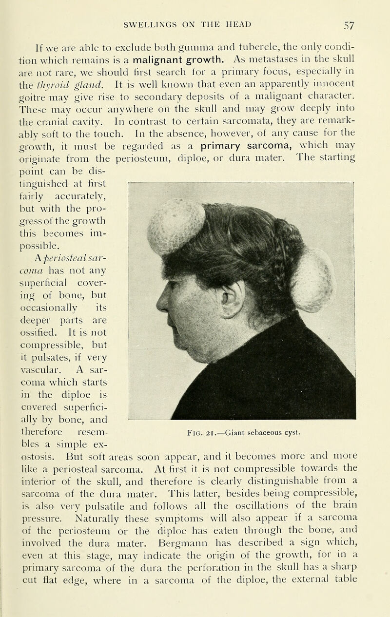 If we are able to exclude both gumma and tubercle, the only condi- tion which remains is a malignant growth. As metastases in the skull are not rare, we should lirst search for a primary focus, especially in the thyroid gland. It is well known that even an apparently innocent goitre may give rise to secondary deposits of a malignant character. These may occur anywhere on the skull and may grow deeply into the cranial cavity. In contrast to certain sarcomata, they are remark- ably soft to the touch. In the absence, however, of any cause for the growth, it must be regarded as a primary sarcoma, which may originate from the periosteum, diploe, or dura mater. The starting point can be dis- tinguished at lirst E^-s-T--— -X—-^^iF---— ■ :-- -| faiiiy accurately, . ^ but with the pro- gress of the growth this becomes im- possible. A periosteal sar- couia has not any superficial cover- ing of bone, but occasionally its •deeper parts are ; ossified. It is not j compressible, but it pulsates, if very vascular. A sar- coma which starts in the diploe is covered superfici- ally by bone, and therefore resem- bles a simple ex- ostosis. But soft areas soon appear, and it becomes more and more like a periosteal sarcoma. At first it is not compressible towards the interior of the skull, and therefore is clearly distinguishable from a sarcoma of the dura mater. This latter, besides being compressible, is also very pulsatile and follows all the oscillations of the brain pressure. Naturally these symptoms will also appear if a sarcoma of the periosteum or the diploe has eaten through the bone, and involved the dura mater. Bergmann has described a sign which, even at this stage, may indicate the origin of the growth, for in a primary sarcoma of the dura the perforation in the skull has a sharp cut flat edge, where in a sarcoma of the diploe, the external table Fig. 21.—Giant sebaceous cyst.