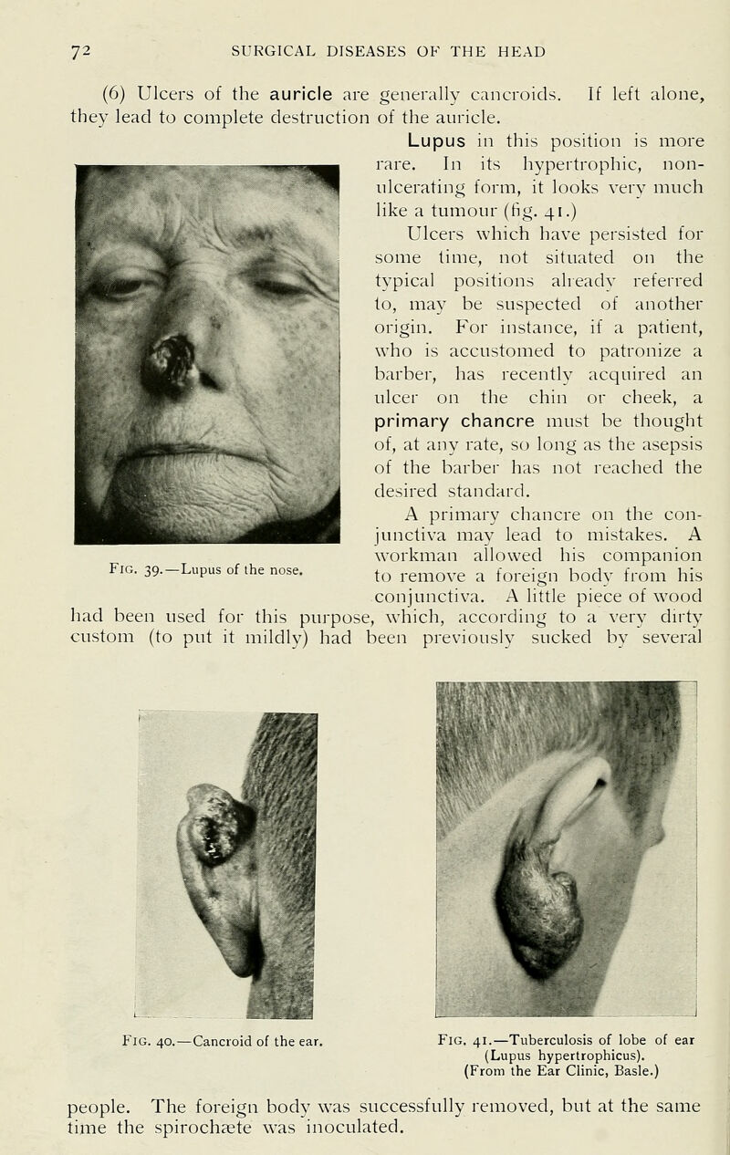 (6) Ulcers of the auricle are generally cancroids. If left alone, they lead to complete destruction of the auricle. Lupus in this position is more rare. In its hypertrophic, non- ulcerating form, it looks very much like a tumour (fig. 41.) Ulcers which have persisted for some time, not situated on the typical positions already referred to, may be suspected of another origin. For instance, if a patient, who is accustomed to patronize a barber, has recently acquired an ulcer on the chin or cheek, a primary chancre must be thought of, at any rate, so long as the asepsis of the barber has not reached the desired standard. A primary chancre on the con- junctiva may lead to mistakes. A workman allowed his companion to remove a foreign body from his conjunctiva. A little piece of wood had been used for this purpose, which, according to a very dniy custom (to put it mildly) had been previously sucked by several Fig. 39.—Lupus of the nose. Fig. 40.—Cancroid of the ear. Fig. 41.—Tuberculosis of lobe of ear (Lupus hypertrophicus). (From the Ear Clinic, Basle.) people. The foreign body was successfully removed, but at the same tiziie the spirochaete was inoculated.