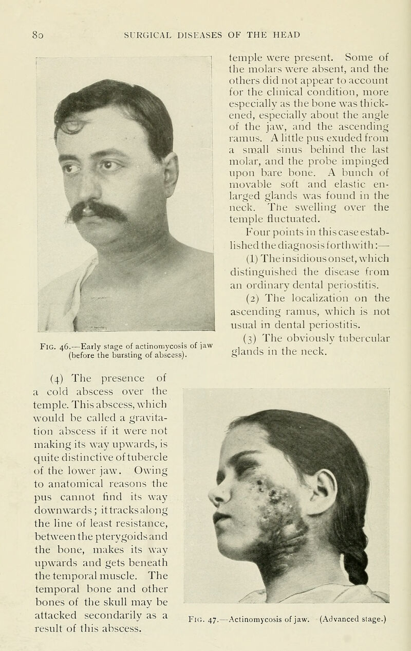 t Fig. 46.—Early stage of actinomycosis of jaw (before the bursting of abscess). temple were present. Some of the molars were absent, and the others did not appear to account for the clinical condition, more especially as the bone was thick- ened, especially about the angle of the jaw, and the ascending ramus. A little pus exuded from a small sinus behind the last molar, and the probe impinged upon bare bone. A bunch of movable soft and elastic en- larged glands was found in the neck temple fluctuated Four points in this case estab- lished the diagnosis forthwith:— (1) The insidious onset, which distinguished the disease from an ordinary dental periostitis. (2) The locahzation on the ascending ramus, which is not usual in dental periostitis. (3) The obviously tubercular glands in the neck. The swelling over the (4) The presence of a cold abscess over the temple. This abscess, which would be called a gravita- tion abscess if it were not making its way upwards, is quite distinctive of tubercle of the lower jaw. Owing to anatomical reasons the pus cannot find its way downwards; it tracks along the line of least resistance, between the pterygoids and the bone, makes its way upwards and gets beneath the temporal muscle. The temporal bone and other bones of the skull may be attacked secondarily as a result of this abscess. Fig. 47.—Actinomycosis of jaw. (Advanced stage.)