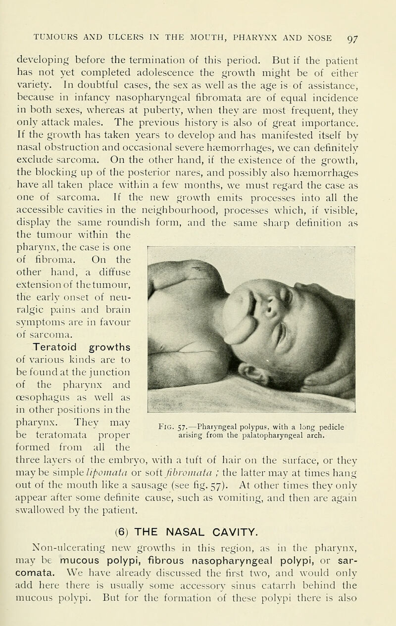 developing before the termination of this period. But if the patient has not yet completed adolescence the growth might be of either variety. In doubtful cases, the sex as well as the age is of assistance, because in infancy nasopharyngeal fibromata are of equal incidence in both sexes, whereas at puberty, when they are most frequent, they only attack males. The previous history is also of great importance. If the growth has taken years to develop and has manifested itself by nasal obstruction and occasional severe haemorrhages, we can definitely exclude sarcoma. On the other hand, if the existence of the growth, the blocking up of the posterior nares, and possibly also haemorrhages have all taken place within a few months, we must regard the case as one of sarcoma. If the new growth emits processes into all the accessible cavities in the neighbourhood, processes which, if visible, display the same roundish form, and the same sharp definition as the tumour within the pharynx, the case is one of fibroma. On the other hand, a diffuse extension of the tumour, the early onset of neu- ralgic pains and brain symptoms are in favour of sarcoma. Teratoid growths of various kinds are to be found at the junction of the pharynx and oesophagus as well as in other positions in the pharynx. They may be teratomata proper formed from all the three layers of the embryo, with a tuft of hair on the surface, or they maybe simple I ipoinata or soit fibromata ; the latter may at times hang out of the mouth like a sausage (see fig. 57). At other times they only appear after some definite cause, such as vomiting, and then are again swallowed by the patient. Fig. 57.—Pharyngeal polypus, with a long pedicle arising from ihe palatopharyngeal arch. (6) THE NASAL CAVITY. Non-ulcerating new growths in this region, as in the pharynx, may be mucous polypi, fibrous nasopharyngeal polypi, or sar- comata. We have already discussed the first two, and would only add here there is usually some accessory sinus catarrh behind the mucous polypi. But for the formation of these polypi there is also