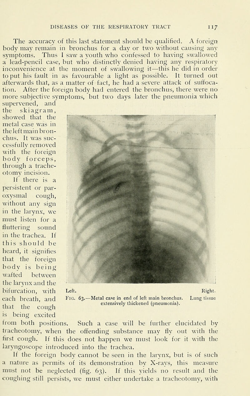 The accuracy of this last statement should be qualified. A foreign body may remain in bronchus for a day or two without causing any symptoms. Thus I saw a youth who confessed to having swallowed a lead-pencil case, but who distinctly denied having any respiratory inconvenience at the moment of swallowing it—this he did in order to put his fault in as favourable a light as possible. It turned out afterwards that, as a matter of fact, he had a severe attack of suffoca- tion. After the foreign body had entered the bronchus, there were no more subjective symptoms, but two days later the pneumonia which supervened, and the skiagram, showed that the metal case was in the left main bron- chus. It was suc- cessfully removed with the foreign body forceps, through a trache- otomy incision. If there is a persistent or par- oxysmal cough, without any sign in the larynx, we must listen for a fluttering sound in the trachea. If this should be heard, it signifies that the foreign body is being wafted between the larynx and the bifurcation, with each breath, and that the cough is being excited from both positions. Such a case will be further elucidated by tracheotomy, when the offending substance may fly out with the first cough. If this does not happen we must look for it with the laryngoscope introduced into the trachea. If the foreign body cannot be seen in the larynx, but is of such a nature as permits of its demonstration by X-rays, this measure must not be neglected (fig. 63). If this yields no result and the coughing still persists, we must either undertake a tracheotomy, with Left. Fig. 63.—Metal case in end of left main bronchus, extensively thickened (pneumonia). Right. Lung tissue