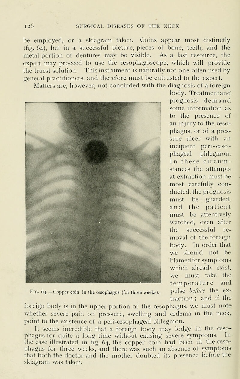 be employed, or a skiagram taken. Coins appear most distinctly (fig. 64), but in a successful picture, pieces of bone, teeth, and the metal portion of dentures may be visible. As a last resource, the expert may proceed to use the oesophagoscope, which will provide the truest solution. This instrument is naturally not one often used by general practitioners, and therefore must be entrusted to the expert. Matters are, however, not concluded with the diagnosis of a foreign body. Treatment and prognosis demand some information as to the presence of an injury to the oeso- phagus, or of a pres- sure ulcer with an incipient peri-oeso- phageal phlegmon. In these circum- stances the attempts at extraction must be most carefully con- ducted, the prognosis must be ^ guarded, and the patient must be attentively watched, even after the successful re- moval of the foreign body. In order that we should not be blamed for symptoms which already exist, we must take the temperature and pulse before the ex- traction ; and if the foreign body is in the upper portion of the oesophagus, we must note whether severe pain on pressure, swelling and oedema in the neck,, point to the existence of a peri-cesophageal phlegmon. It seems incredible that a foreign body may lodge in the oeso- phagus for quite a long time without causing severe symptoms. In the case illustrated in fig. 64, the copper coin had been in the oeso- phagus for three weeks, and there was such an absence of symptoms- that both the doctor and the mother doubted its presence before the skiagram was taken. Fig. 64.—Copper coin in ihe oesophagus (for three weeks)