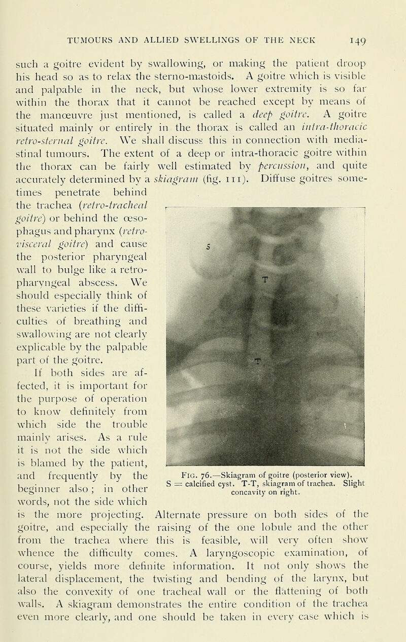 such a goitre evident by swallowing, or making the patient droop his head so as to relax the sterno-mastoids. A goitre which is visible and palpable in the neck, but whose lower extremit)^ is so far within the thorax that it cannot be reached except by means of the manoeuvre just mentioned, is called a deep goitre. A goitre situated mainly or entirely in the thorax is called an infra-tlioracic retro-sternal goitre. We shall discuss this in connection with media- stinal tumours. The extent of a deep or intra-thoracic goitre within the thorax can be fairly well estimated by percussion, and quite accurately determined by a skiagram (fig. iii). Diffuse goitres some- times penetrate behind the trachea {retro-tracJieal goitre) or behind the oeso- phagus and pharynx (retro- %'isceral goitre) and cause the posterior pharyngeal wall to bulge like a retro- pharyngeal abscess. We should especially think of these varieties if the diffi- culties of breathing and swallowing are not clearly explicable by the palpable part of the goitre. If both sides are af- fected, it is important for the purpose of operation to know definitely from which side the trouble mainly arises. As a rule it is not the side which is blamed by the patient, and frequently by the beginner also ; in other words, not the side which is the more projecting. Alternate pressure on both sides of the goitre, and especially the raising of the one lobule and the other from tlie trachea where this is feasible, will very often show whence the difficulty comes. A laryngoscopic examination, of course, yields more definite information. It not only shows the lateral displacement, the twisting and bending of the larynx, but also the convexity of one tracheal wall or the flattening of both walls. A skiagram demonstrates the entire condition of the trachea even more clearly, and one should be taken in every case which is Fig. 76.—Skiagram of goitre (posterior view). S = calcified cyst. T-T, skiagram of trachea. Slight concavity on right.