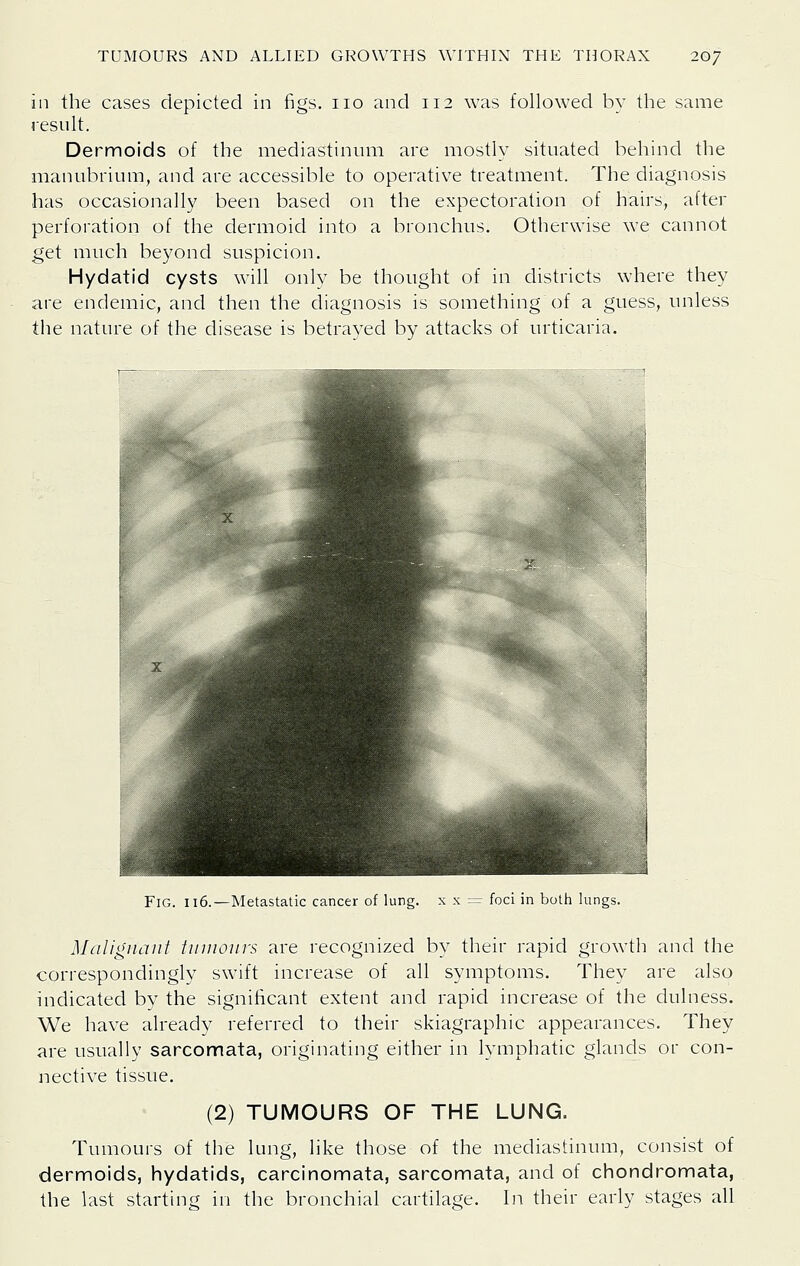 in the cases depicted in figs, no and 112 was followed by the same iesult. Dermoids of the mediastinum are mostly situated behind the manubrium, and are accessible to operative treatment. The diagnosis has occasionally been based on the expectoration of hairs, after perforation of the dermoid into a bronchus. Otherwise we cannot get much beyond suspicion. Hydatid cysts will only be thought of in districts where they are endemic, and then the diagnosis is something of a guess, unless tlie nature of the disease is betrayed by attacks of urticaria. Fig. 116.—Metastatic cancer of lung, x x = foci in both lungs. Malignant iinuoiin are recognized by their rapid growth and the correspondingly swift increase of all symptoms. They are also indicated by the significant extent and rapid increase of the dulness. We have already referred to their skiagraphic appearances. They are usually sarcomata, originating either in lymphatic glands or con- nective tissue. (2) TUMOURS OF THE LUNG. Tumours of the lung, like those of the mediastinum, consist of dermoids, hydatids, carcinomata, sarcomata, and of chondromata, the last starting in the bronchial cartilage. In their early stages all