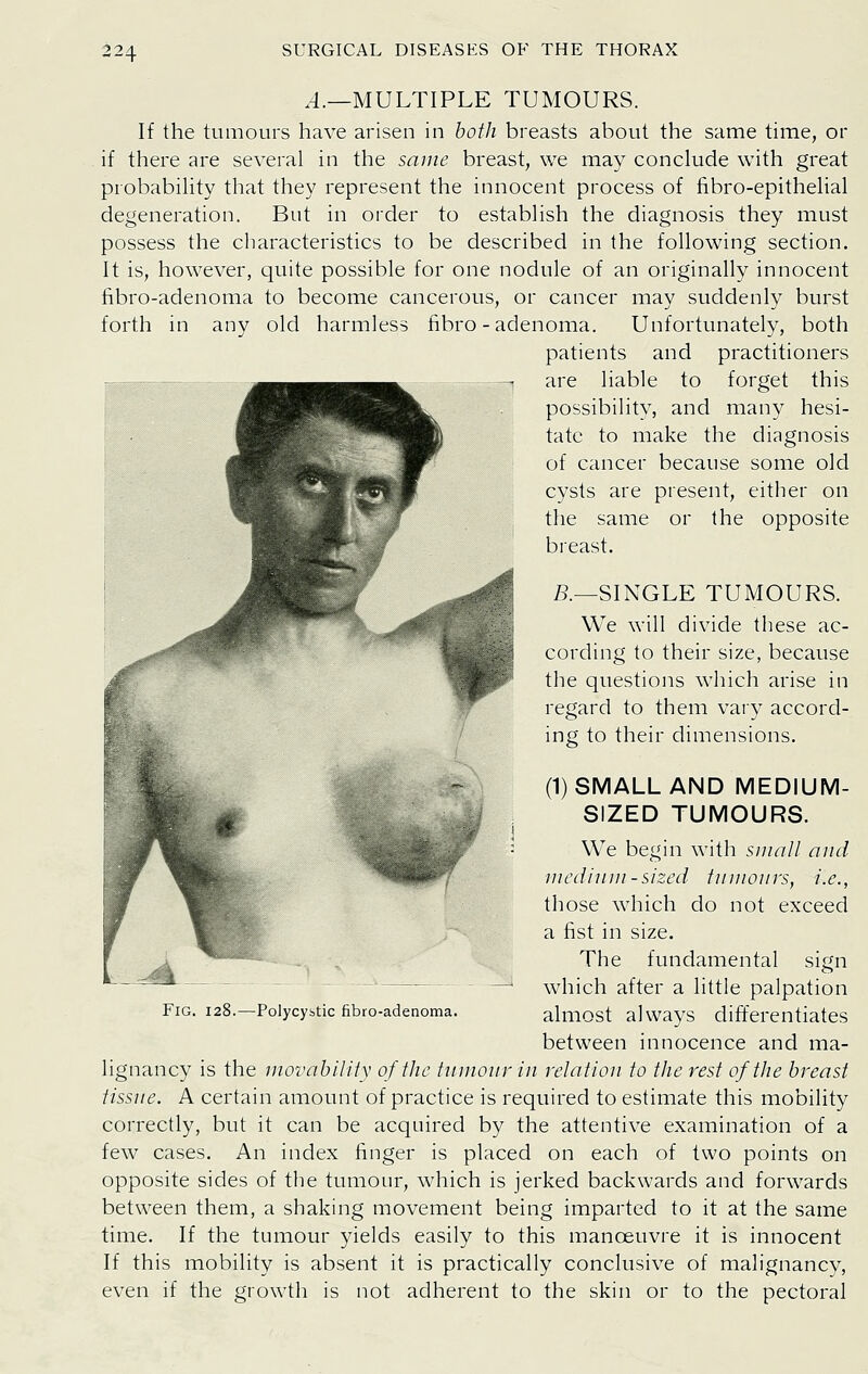 ^.—MULTIPLE TUMOURS. If the tumours have arisen in both breasts about the same time, or if there are several in the same breast, we may conclude with great probability that they represent the innocent process of fibro-epithelial degeneration. But in order to establish the diagnosis they must possess the characteristics to be described in the following section. It is, however, quite possible for one nodule of an originally innocent fibro-adenoma to become cancerous, or cancer may suddenly burst forth in any old harmless fibro-adenoma. Unfortunately, both patients and practitioners are liable to forget this possibility, and many hesi- tate to make the diagnosis of cancer because some old cysts are present, either on the same or the opposite breast. R—SINGLE TUMOURS. We will divide these ac- cording to their size, because the questions which arise in regard to them vary accord- ing to their dimensions. (1) SMALL AND MEDIUM- SIZED TUMOURS. We begin with suiall and iiiediuiii-sized tumours, i.e., those which do not exceed a fist in size. The fundamental sign which after a little palpation almost always differentiates between innocence and ma- lignancy is the movahility of the tumour in relatiou to the rest of the breast tissue. A certain amount of practice is required to estimate this mobility correctly, but it can be acquired by the attentive examination of a few cases. An index finger is placed on each of two points on opposite sides of the tumour, which is jerked backwards and forwards between them, a shaking movement being imparted to it at the same time. If the tumour yields easily to this manoeuvre it is innocent If this mobility is absent it is practically conclusive of malignancy, even if the growth is not adherent to the skin or to the pectoral Fig. 128.—Polycybtic fibro-adenoma.