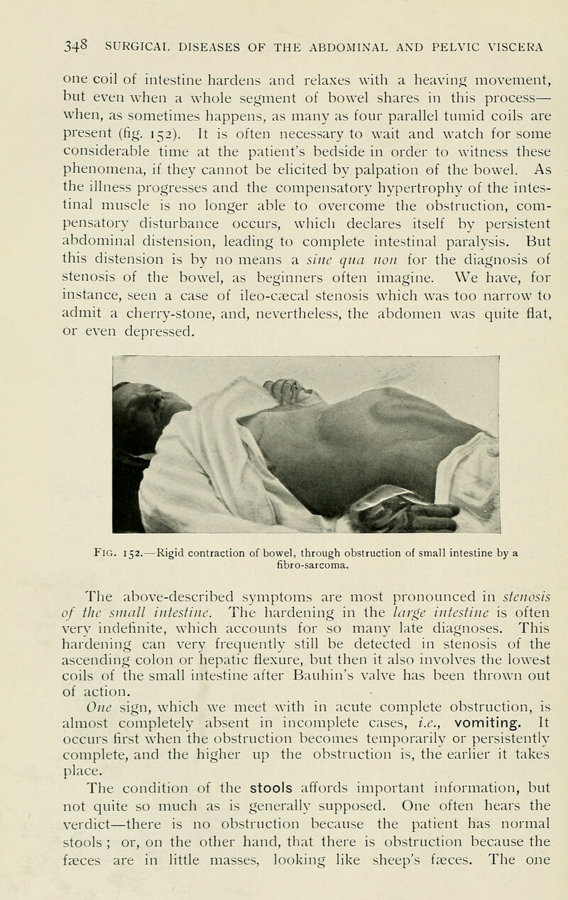 one coil of intestine hardens and relaxes with a heaving movement, but even when a whole segment of bowel shares in this process— when, as sometimes happens, as many as four parallel tumid coils are present (fig. 152). It is often necessary to wait and watch for some considerable time at the patient's bedside in order to witness these phenomena, if they cannot be elicited by palpation of the bowel. As the illness progresses and the com.pensatory hypertrophy of the intes- tinal muscle is no longer able to overcome the obstruction, com- pensatory disturbance occurs, which declares itself by persistent abdominal distension, leading to complete intestinal paralysis. But this distension is by no means a sine qua iioii for the diagnosis of stenosis of the bowel, as beginners often imagine. We have, for instance, seen a case of ileo-caecal stenosis which was too narrow to admit a cherry-stone, and, nevertheless, the abdomen was quite flat, or even depressed. Fig. 152.—Rigid contraction of bowel, through obstruction of small intestine by a fibro-sarcoma. The above-described symptoms are most pronounced in stenosis of the small intestine. The hardening in the targe intestine is often very indefinite, which accounts for so many late diagnoses. This hardening can very frequently still be detected in stenosis of the ascending colon or hepatic flexure, but then it also involves the lowest coils of the small intestine after Bauhin's valve has been thrown out of action. One sign, which we meet with in acute complete obstruction, is almost completely absent in incomplete cases, i.e., vomiting. It occurs first when the obstruction becomes temporarily or persistently complete, and the higher up the obstruction is, the earlier it takes place. The condition of the stools affords important information, but not quite so much as is generally supposed. One often hears the verdict—there is no obstruction because the patient has normal stools ; or, on the other hand, that there is obstruction because the faeces are in little masses, looking like sheep's faeces. The one