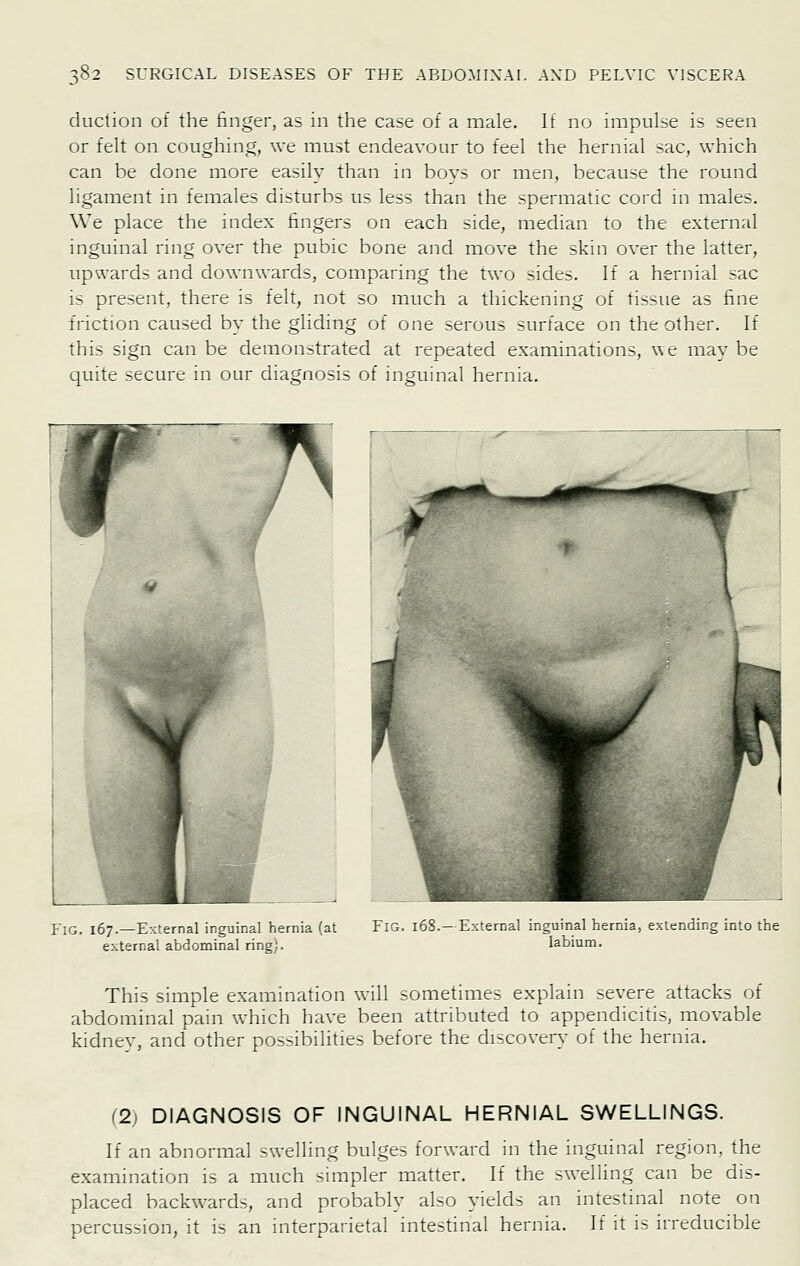 duction of the finger, as in the case of a male. It no impulse is seen or felt on coughing, we must endeavour to feel the hernial ^ac, which can be done more easily than in bovs or men, because the round ligament in females disturbs us less than the spermatic coi'd m males. We place the index fingers on each side, median to the external inguinal ring over the pubic bone and move the skin over the latter, upwards and downwards, comparing the two sides. If a hernial sac is present, there is felt, not so much a thickening of tissue as fine friction caused by the gliding of one serous surface on the other. If this sign can be demonstrated at repeated examinations, we may be quite secure in our diagnosis of inguinal hernia. Fig. 167.—External inguinal hernia (at external abdominal ring;. Fig. 168. — External inguinal hernia, extending into the labium. This simple examination will sometimes explain severe attacks of abdominal pain which have been attributed to appendicitis, movable kidnev, and other possibilities before the di-xovery of the hernia. (2) DIAGNOSIS OF INGUINAL HERNIAL SWELLINGS. If an abnormal -welling bulges forward in the inguinal region, the examination is a much -nnpler matter. If the swelling can be dis- placed backwards, and probably also yields an intestinal note on percussion, it is an interparietal intestinal hernia. If it is irreducible