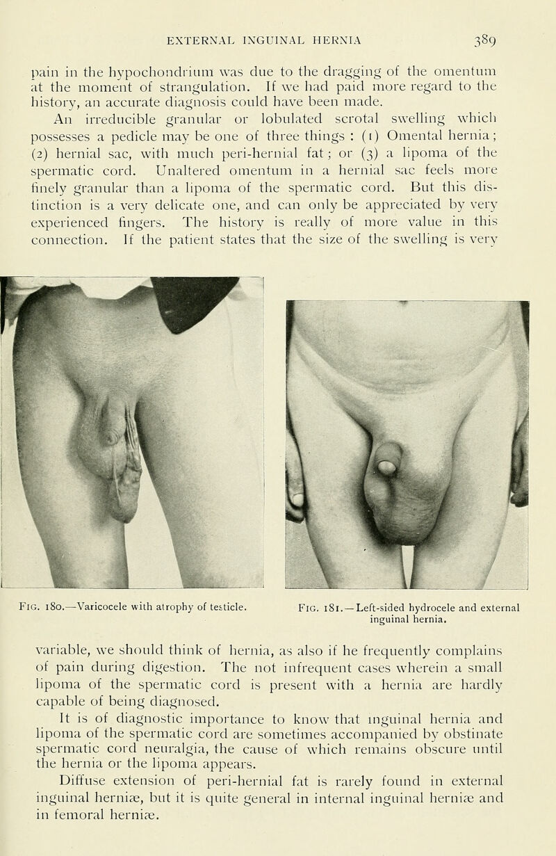 pain in the hypochondriuni was due to the dragging of the omentum at the moment of strangulation. If we had paid more regard to the history, an accurate diagnosis could have been made. An irreducible granular or lobulated scrotal swelling which possesses a pedicle may be one of three things : (i) Omental hernia; (2) hernial sac, with much peri-hernial fat; or (3) a lipoma of the spermatic cord. Unaltered omentum in a hernial sac feels more finely granular than a lipoma of the spermatic cord. But this dis- tinction is a very delicate one, and can only be appreciated by very experienced fingers. The history is really of more value in this connection. If the patient states that the size of the swelling is very Fig. 180.—Varicocele with atrophy of testicle. Fig. 181. —Left-sided hydrocele and external inguinal hernia. variable, we should think of hernia, as also if he frequently complains of pain during digestion. The not infrequent cases wherein a small lipoma of the spermatic cord is present with a hernia are hardly capable of being diagnosed. It is of diagnostic importance to know that mguinal hernia and lipoma of the spermatic cord are sometimes accompanied by obstinate spermatic cord neuralgia, the cause of which remains obscure until the hernia or the lipoma appears. Diffuse extension of peri-hernial fat is rarely found in external inguinal herniae, but it is quite general in internal inguinal herniae and in femoral herniae.