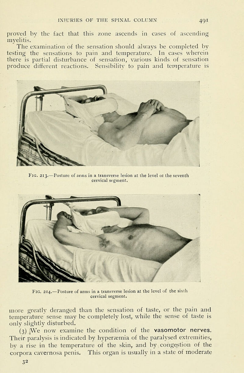 proved by the fact that this zone ascends in cases of ascending myehtis. The examination of the sensation should always be completed by testing the sensations to pain and temperature. In cases wherein there is partial disturbance of sensation, various kinds of sensation produce different reactions. Sensibility to pain and temperature is Fig. 213.—Posture of arms in a transverse lesion at the level ot the seventh cervical segment. Fig. 214.—Posture of arms in a transverse lesion at the level of the sixth cervical segment. more greatly deranged than the sensation of taste, or the pain and temperature sense may be completely lost, while the sense of taste is only slightly disturbed. (3) jWe now examine the condition of the vasomotor nerves. Their paralysis is indicated by hyperaemia of the paralysed extremities, by a rise in the temperature of the skin, and by congestion of the corpora cavernosa penis 32 This organ is usuallv in a state of moderate