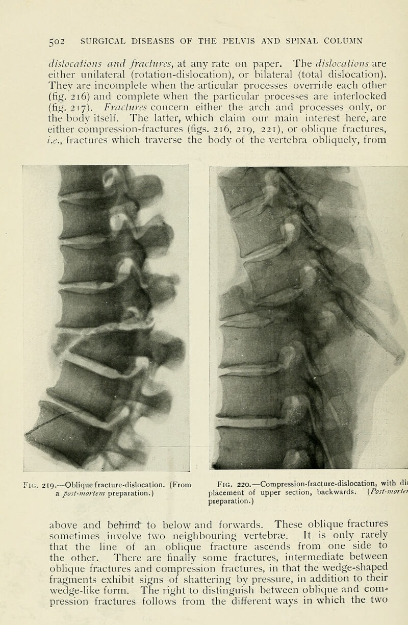 dislocations and fractures, at any rate on paper. The dislocations are either unilateral (rotation-dislocation), or bilateral (total dislocation). Thev are incomplete when the articular processes override each other (fig. 216) and complete when the particular processes are interlocked (fig. 217). Fractures conctvn either the arch and processes only, or the body itself. The latter, which claim our main interest here, are either compression-fractures (figs. 216, 219, 221), or oblique fractures, i.e., fractures which traverse the body of the vertebra obliquely, from Fig. 219.—Oblique fracture-dislocation. (From a pust-viortem preparation.) Fig. 220.—Compression-fracture-dislocation, with dis placement of upper section, backwards. {Post-moriet. preparation.) above and behhid to below and forwards. These oblique fractures sometimes involve two neighbouring vertebrce. It is only rarely that the line of an oblique fracture ascends from one side to the other. There are finally some fractures, intermediate between oblique fractures and compression fractures, in that the wedge-shaped fragments exhibit signs of shattering by pressure, in addition to their wedge-like form. The right to distinguish between oblique and com-' pression fractures follows from the different ways in which the two