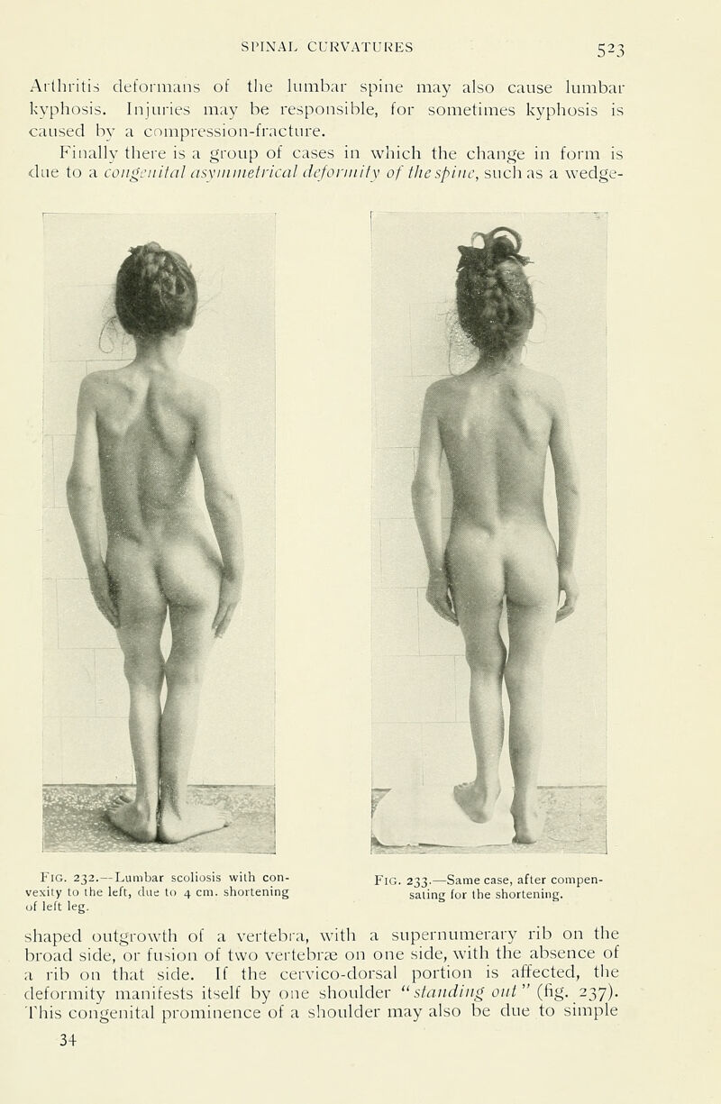 Arthritis deformans of the lumbar spine may also cause lumbar kyphosis. Injuries may be responsible, for sometimes kyphosis is caused bv a compression-fracture. P'inally there is a group of cases in which the change in form is due to a congenital asyininetrical dcforniitv of the spine, such as a wedge- FiG. 232.—Lumbar scoliosis with con- vexity to the left, due to 4 cm. shortening of left leg. Fig. 233.—Same case, after compen- sating for the shortening. shaped outgrowth of a vertebra, with a supernumerary rib on the broad side, or fusion of two vertebrae on one side, with the absence of a rib on that side. If the cervico-dorsal portion is affected, the deformity manifests itself by one shoulder standing out (fig. 237). This congenital prominence of a shoulder may also be due to simple 34