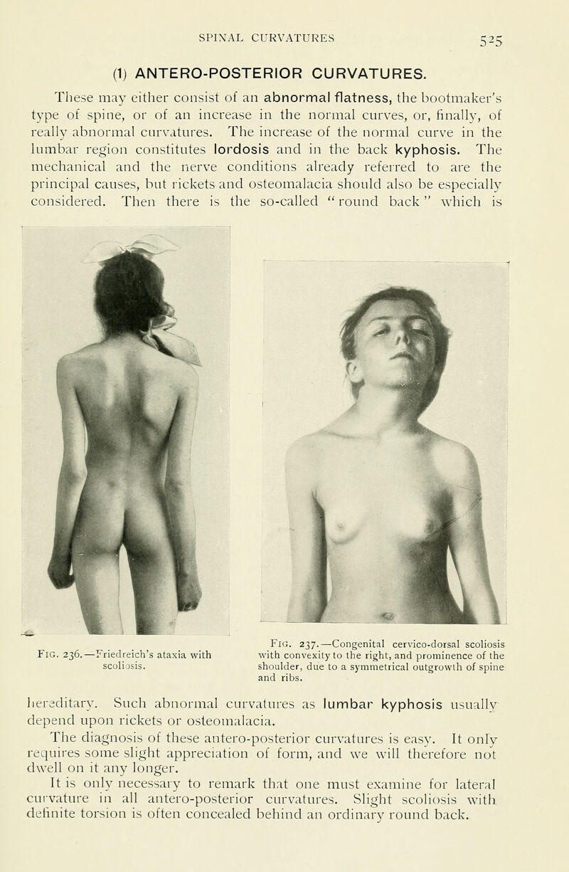 (1) ANTERO-POSTERIOR CURVATURES. These may either consist of an abnormal flatness, the bootmaker's type of spine, or of an increase in the normal curves, or, finally, of really abnormal curvatures. The increase of the normal curve in the lumbar region constitutes lordosis and in the back kyphosis. The mechanical and the nerve conditions already referred to are the principal causes, but rickets and osteomalacia should also be especially considered. Then there is the so-called  round back which is Fig. 236.—Friedreich's ataxia with scoliosis. Fig. 237.—Congenital cervico-dorsal scoliosis with convexity to the right, and prominence of the shoulder, due to a symmetrical outgrowth of spine and ribs. iiereditary. Such abnormal curvatures as lumbar kyphosis usually depend upon rickets or osteomalacia. The diagnosis of these antero-posterior curvatures is easy. It only requires some slight appreciation of form, and we will therefore not dwell on it any longer. It is only necessary to remark that one must examine for lateral curvatui-e in all antero-posterior curvatures. Slight scoliosis with definite torsion is often concealed behind an ordinary round back.