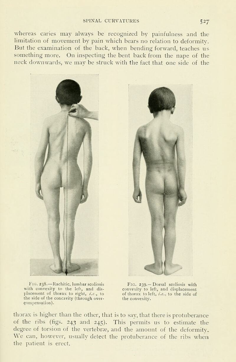 whereas caries may always be recognized by painfulness and the- limitation of movement by pain which bears no relation to deformit3\ But the examination of the back, when bending forward, teaches us something more. On inspecting the bent back from the nape of the neck downwards^ we may be struck with the fact that one side of the ^^ Fig. 238.—Rachitic, lumbar scoliosis with convexity to the lefr, and dis- placement of thorax to right, i.e., to the side of the concavity (through over- compensation). Fig. 239.— Dorsal scoliosis with convexity to left, and displacement of thorax to left, i.e., to the side of the convexity. thorax is higher than the other, that is to say, that there is protuberance of the ribs (figs. 243 and 245). This permits us to estimate the degree of torsion of the vertebrje, and the amount of the deformity. We can, however, usually detect the protuberance of the ribs when the patient is erect.