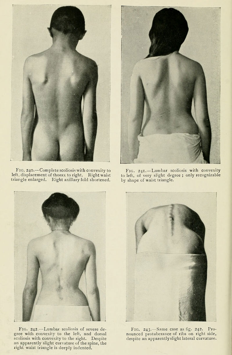 Fig. 240.—Complete scoliosis with convexity to left, displacement of thorax to right. Right waist triangle enlarged. Right axillary fold shortened. Fig. 241.—Lumbar scoliosis with convexity to left, of very slight degree ; only recognizable by shape of waist triangle. Fig. 242.—Lumbar scoliosis of severe de- gree with convexity to the left, and dorsal scoliosis with convexity to the right. Despite an apparently slight curvature of the spine, the right waist triangle is deeply indented. Fig. 243.—Same case as fig. 242. Pro- nounced protuberance of ribs on right side, despite an apparently slight lateral curvature.