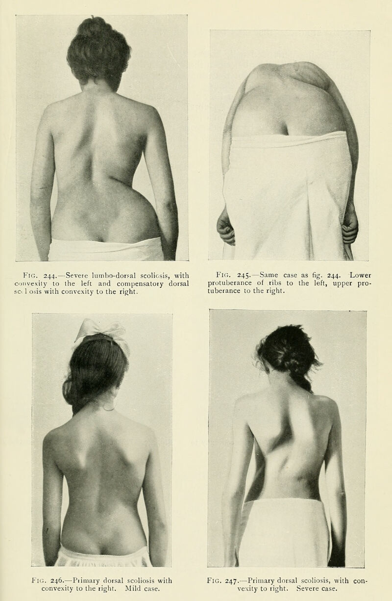 Fig. 244.—Severe lumbo-dorsal scoliosis, with convexity to the left and compensatory dorsal set 1 Oils with convexity to the right. Fig. 245.—Same case as fig. 244. Lower protuberance of ribs to the left, upper pro- tuberance to the right. Fig. 246.—-Piimary dorsal scoliosis with convexity to the right. Mild case. Fig. 247.—Primary dorsal scoliosis, with con- vexity to right. Severe case.