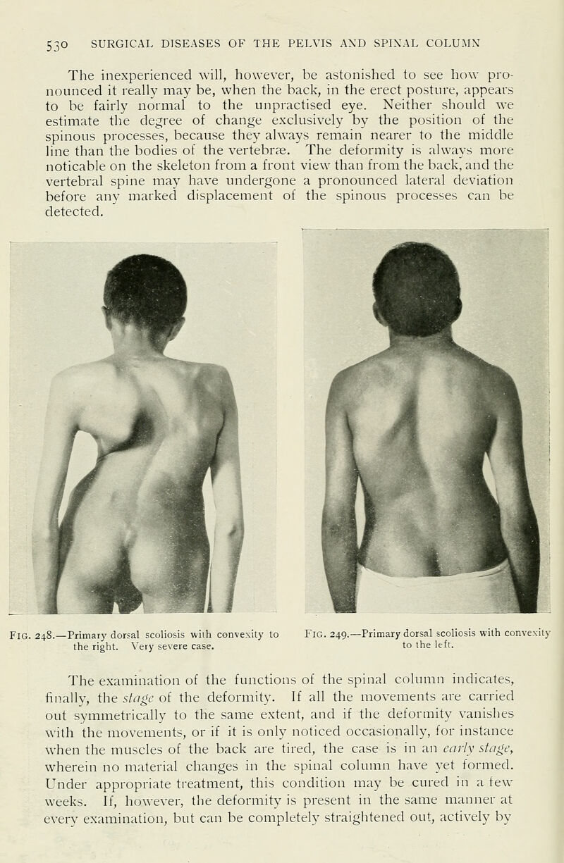 The inexperienced will, however, be astonished to see how pro- nounced it really may be, when the back, in the erect posture, appears to be fairly normal to the unpractised eye. Neither should we estimate the degree of change exclusively by the position of the spinous processes, because they always remain nearer to the middle line than the bodies of the vertebras. The deformity is always more noticable on the skeleton from a front view than from the back, and the vertebral spine may have undergone a pronounced lateral deviation before any marked displacement of the spinous processes can be detected. Fig. 248.—Primary dorsal scoliosis wilh convexity to the right. Very severe case. Fig. 249.—Primary dorsal scoliosis with convexity to the left. The examination of the functions of the spinal column indicates, fin.ally, the stage of the deformity. If all the movements are carried out symmetrically to the same extent, and if the deformity vanishes with the movements, or if it is only noticed occasionally, for instance when the muscles of the back are tired, the case is in an early stage, wherein no material changes in the spinal column have yet formed. Under appropriate treatment, this condition may be cured in a few weeks. If, however, the deformity is present in the same manner at every examination, but can be completely straightened out, actively by