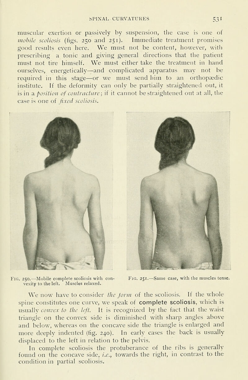 muscular exertion or passively by suspension, the case is one of iiiobile scoliosis (figs. 250 and 251). Immediate treatment promises good results even here. We must not be content, however, witln prescribing a tonic and giving general directions that the patient must not tire himself. We must either take the treatment in hand ourselves, energetically^and complicated apparatus may not be required in this stage—or we must send him to an orthopaedic institute. If the deformity can only be partially straightened out, it is in a. position of contracture; if it cannot be straightened out at all, the case is one of fixed scoliosis. Fig. 250.—Mobile complete scoliosis with con- vexity to the left. Muscles relaxed. Fig. 251.—Same case, with the muscles tense. We now have to consider tlie Jonii of the scoliosis. If the whole spine constitutes one carve, we speak of complete scoliosis, which is usually convex to the left. It is recognized by the fact that the waist triangle on the convex side is diminished with sharp angles above and below, whereas on the concave side the triangle is enlarged and more deeply indented (fig. 240). In early cases the back is usually displaced to the left in relation to the pelvis. In complete scoliosis the protuberance of the ribs is generally found on the concave side, i.e., towards the right, in contrast to the condition in partial scoliosis.