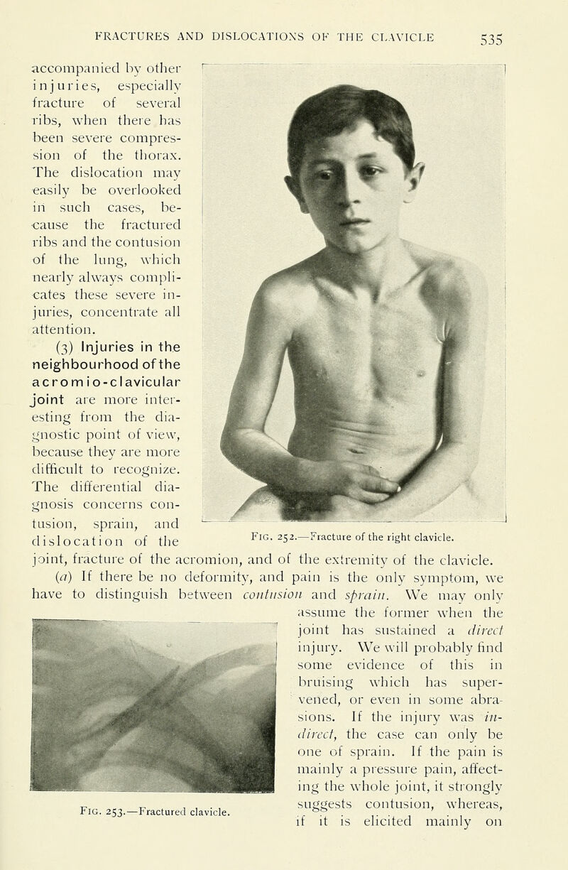 accompanied by other injuries, especially fracture of several ribs, when there has been severe compres- sion of the thorax. The dislocation may easily be overlooked in such cases, be- cause the fractured ribs and the contusion of the lung, which nearly always compli- cates these severe in- juries, concentrate all attention. (3) Injuries in the neighbourhood of the acromio-clavicular joint are more inter- esting from the dia- gnostic point of view, loecause they are more difficult to recognize. The differential dia- gnosis concerns con- tusion, sprain, and dislocation of the :j Fig. 252.—Fracture of the right clavicle. joint, fracture of the acromion, and of the extremity of the clavicle. (a) If there be no deformity, and pain is the only symptom, we have to distinguish between contusion and sprain. We may onlv assume the former when the joint has sustained a direct injury. We will probably find some evidence of this in bruising which has super- vened, or even in some abra- sions. If the injury was in- direct, the case can only be one of sprain. If the pain is mainly a pressure pain, affect- ing the whole joint, it strongly suggests contusion, whereas, if it is elicited mainly on Fig. 253.—Fractured clavicle.