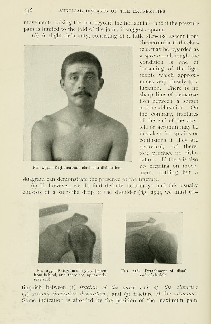 movement—raising the arm beyond the horizontal—and if the pressure pain is limited to the fold of the joint, it suggests sprain. {b) A slight deformity, consisting of a little step-like ascent from the acromion to the clav- icle, may be regarded as a sprain-—although the condition is one of loosening of the liga- ments which approxi- mates very closely to a luxation. There is no sharp line of demarca- tion between a sprain and a subluxation. On the contrary, fractures of the end of the clav- icle or acromin may be mistaken for sprains or contusions if they are periosteal, and there- fore produce no dislo- cation. If there is also no crepitus on move- ment, nothing but a skiagram can demonstrate the presence of the fracture. (c) If, however, we do find definite deformity—and this usually consists of a step-like drop of the shoulder (fig. 254), we must dis- FlG. 254.—Right acromio-clavicular dislocation. Fig. 255.—Skiagram of fig. 254 (taken from behmd, and therefore, apparently reversed). Fig. 256.—Detachment of distal end of clavicle. tinguish between (i) fracture of the outer end of ilie clavicle; (2) acromio-clavicular dislocatiou; and (3) fracture of the acroniiou. Some indication is afforded by the position of the maximum pain