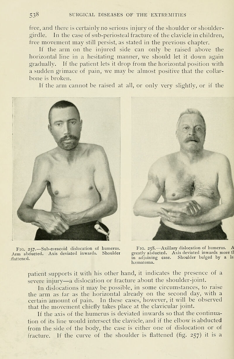 free, and there is certainly no serious injury of the shoulder or shoulder- girdle. In the case of sub-periosteal fracture of the clavicle in children, free movement may still persist, as stated in the previous chapter. If the arm on the injured side can only be raised above the horizontal line in a hesitating manner, we should let it down again gradually. If the patient lets it drop from the horizontal position with a sudden grimace of pain, we may be almost positive that the collar- bone is broken. If the arm cannot be raised at all, or only very slightly, or if the L Fig. 257.—Sub-coracoid dislocation of humerus. Arm abducted. Axis deviated inwards. Shoulder i^attened. Fig. 258.—Axillary dislocalion of humerus. A greatly afjducted. Axis deviated inwards more ii in adjoining case. Shoulder bulged by a lai hiiemaloma. patient supports it with his other hand, it indicates the presence of a severe injury—a dislocation or fracture about the shoulder-joint. In dislocations it may be possible, in some circumstances, to raise the arm as far as the horizontal already on the second day, with a certain amount of pain. In these cases, however, it will be observed that the movement chiefly takes place at the clavicular joint. If the axis of the humerus is deviated inwards so that the continua- tion of its line would intersect the clavicle, and if the elbow is abducted from the side of the body, the case is either one of dislocation or of fracture. If the curve of the shoulder is flattened (fig. 257) it is a