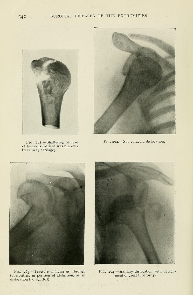 Fig. 261.— Shattering of head of humerus (patient was run over by railway carriage). Fig. 262.—Sub-coracoid dislocation. Fig. 263.—Fracture of humetus, through tuberosities, in position of abduction, as in dislocation {cf, fig. 262). Fig. 264.—Axillary dislocation with detach- ment of great tuberosity.