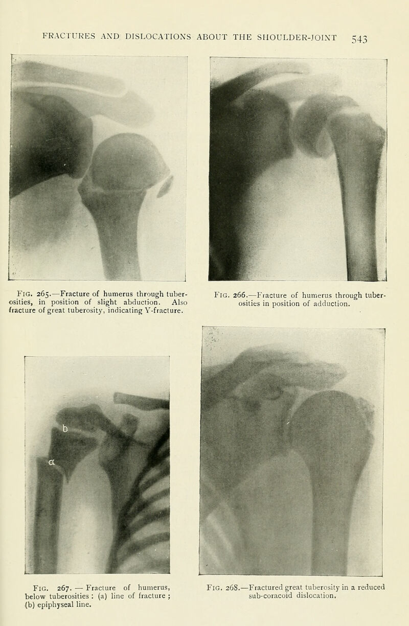 Fig. 265.—Fracture of humerus through tuber- osities, in position of slight abduction. Also fracture of great tuberosity, indicating Y-fracture. Fig. 266.—Fracture of humerus through tuber- osities in position of adduction. Fig. 267. — Fracture of humerus, below tuberosities : (a) line of fracture ; (b) epiphyseal line. Fig. 268.—Fractured great tuberosity in a reduced sub-coracoid dislocaiion.