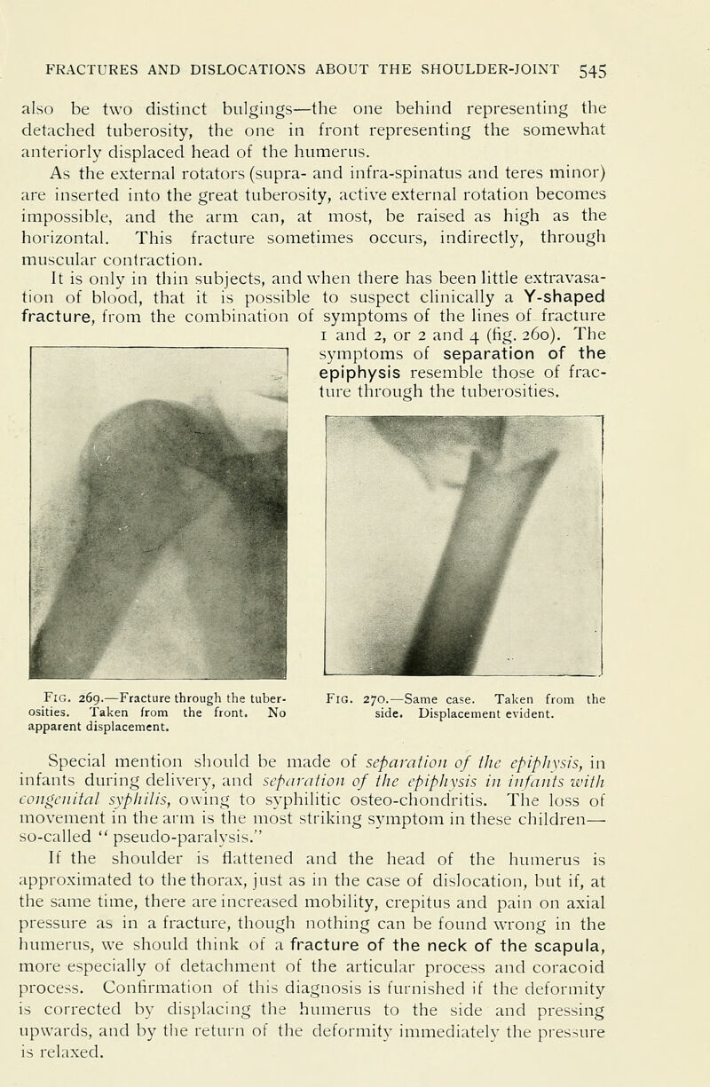 also be two distinct bulgings—the one behind representing the detached tuberosity, the one in front representing the somewhat anteriorly displaced head of the humerus. As the external rotators (supra- and infra-spinatus and teres minor) are inserted into the great tuberosity, active external rotation becomes impossible, and the arm can, at most, be raised as high as the horizontal. This fracture sometimes occurs, indirectly, through muscular contraction. It is only in thin subjects, and when there has been little extravasa- tion of blood, that it is possible to suspect clinically a Y-shaped fracture, from the combination of symptoms of the lines of fracture I and 2, or 2 and 4 (fig. 260). The symptoms of separation of the epiphysis resemble those of frac- ture through the tuberosities. Fig. 269.—Fracture through the tuber- osities. Taken from the front. No apparent displacement. Fig. 270.—Same case. Taken from the side. Displacement evident. Special mention should be made of separation of fJie epiplixsis, in infants during delivery, and separation of the epiphysis in infants with congenital syphilis, owing to syphilitic osteo-chondritis. The loss of movement in the arm is the most striking symptom in these children— so-called  pseudo-paralysis. If the shoulder is flattened and the head of the humerus is approximated to the thorax, just as in the case of dislocation, but if, at the same time, there are increased mobility, crepitus and pain on axial pressure as in a fracture, though nothing can be found wrong in the humerus, we should think of a fracture of the neck of the scapula, more especially of detachment of the articular process and coracoid process. Confirmation of this diagnosis is furnished if the deformity is corrected by displacing the humerus to the side and pressing upwards, and by the return of the deformity immediately the pressure is relaxed.