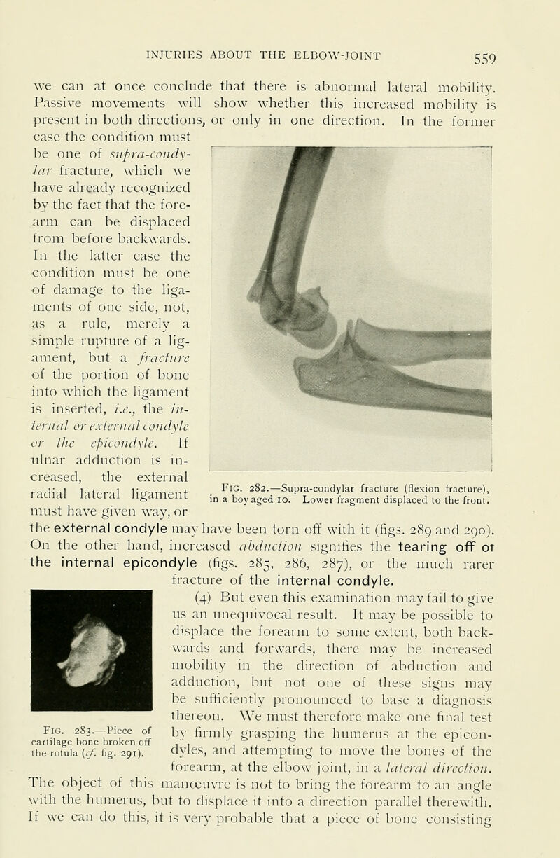 we can at once conclude that there is abnormal lateral mobility. Passive movements will show whether this increased mobility is present in both directions, or only in one direction. In the former case the condition must be one of supra-condv- lar fracture, which we have already recognized by the fact that the fore- arm can be displaced from before backwards. In the latter case the condition must be one of damage to the liga- ments of one side, not, as a rule, merely a simple rupture of a lig- ament, but a fracture of the portion of bone into which the ligament is inserted, i.e., the in- ternal or external condyle or the epicondvle. If ulnar adduction is in- creased, the external radial lateral ligament must have given way, or the external condyle may have been torn off with it (figs. 289 and 290). On the other hand, increased abduction signifies the tearing off or the internal epicondyle (figs. 285, 286, 287), or the much rarer fracture of the internal condyle. (4) But even this examination may fail to give us an unequivocal result. It may be possible to displace the forearm to some extent, both back- wards and forwards, there may be increased mobility in the direction of abduction and adduction, but not one of these signs may be sufificiently pronounced to base a diagnosis thereon. We must therefore make one final test by firmly grasping the humerus at the epicon- dyles, and attempting to move the bones of the forearm, at the elbow joint, in a lateral direction. The object of this manoeuvre is not to bring the forearm to an angle with the humerus, but to displace it into a direction parallel therewith. If we can do this, it is very probable that a piece of bone consisting Fig. 282.—Supra-condylar fracture (flexion fracture), in a boy aged lo. Lower fragment displaced to the front. Fig. 283.—Piece of cartilage bone broken off the rotula ((/. fig. 291).