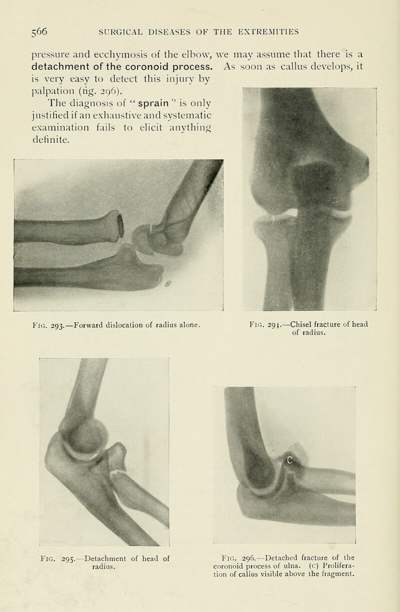 pressure and ecchymosis of the elbow, we may assume that there is a detachment of the coronoid process. As soon as callus develops, it is very easy to detect this injury by palpation (ng. 296). The diagnosis of  sprain  is only justified if an exhaustive and systematic examination fails to elicit anything definite. Fig. 293.—Forward dislocation of radius alone. Fig. 294.—Chisel fracture of head of radius. Fig. 295.—Detachment of head of radius. Fig. 296.—Detached fracture of the coronoid process of ulna, (c) Prolifera- tion of callus visible above the fragment.