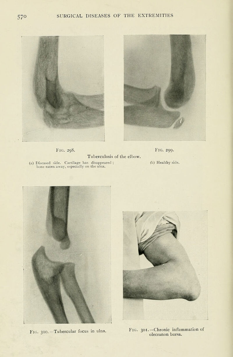 Fig. 298. Tuberculosis of the elbow. (a) Diseased side. Cartilage has disappeared ; bone eaten away, especially on the ulna. Fig. 299. (b) Healthy side. Fig. 300.—Tubercular focus in ulna. Fig. 301.—Chronic inflammation of olecranon bursa.