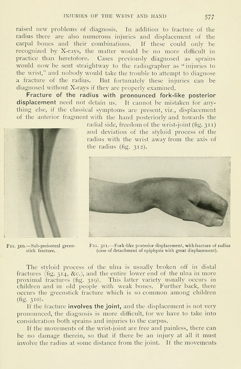 raised new problems of diagnosis. In addition to fracture of the radius there are also numerous injuries and displacement of the carpal bones and their combinations. If these could only be recognized by X-rays, the matter would be no more difficult in practice than heretofore. Cases previously diagnosed as sprains would now be sent straightway to the radiographer as injuries to the wrist, and nobody would take the trouble to attempt to diagnose a fracture of the radius. But fortunately these injuries can be diagnosed without X-rays if they are properly examined. Fracture of the radius with pronounced fork-like posterior displacement need not detain us. It cannot be mistaken for any- thing else, if the classical symptoms are present, viz., displacement of the antei-ior fragment with the hand posteriorly and towards the radial side, freedom of the wrist-joint (fig. 311) and deviation of the styloid process of the radius with the wrist away from the axis of the radius (fig. 312). Fig. 310.—Sub-periosteal green- stick fracture. Fig. 311.—Fork-like posterior displacement, withfraclure of radius (case of detachment of epiphysis with great displacement). The styloid process of the ulna is usually broken off in distal fractures (fig. 314, &c.), and the entire lower end of the ulna in more proximal fractures (fig. 319). This latter variety usually occurs in children and in old people with weak bones. Further back, there occurs the greenstick fracture which is so common among children (fig- 310)- If the fracture involves the joint, and the displacement is not very pronounced, the diagnosis is more difficult, for we have to take into consideration both sprains and injuries to the carpus. If the movements of the wrist-joint are free and painless, there can be no damage therein, so that if there be an injury at all it must involve the radius at some distance from the joint. If the movements