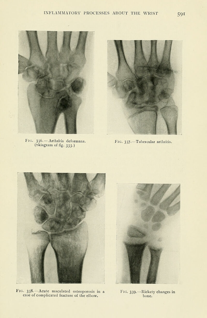 Fic. 336. —Arthritis deformans. (Skiagram of fig. 333.) Fig. 337.—Tubercular arthritis. Fig. 338.—Acute maculated osteoporosis in a case of complicated fracture of the elbow. Fig. 339.—Rickety changes in bone.