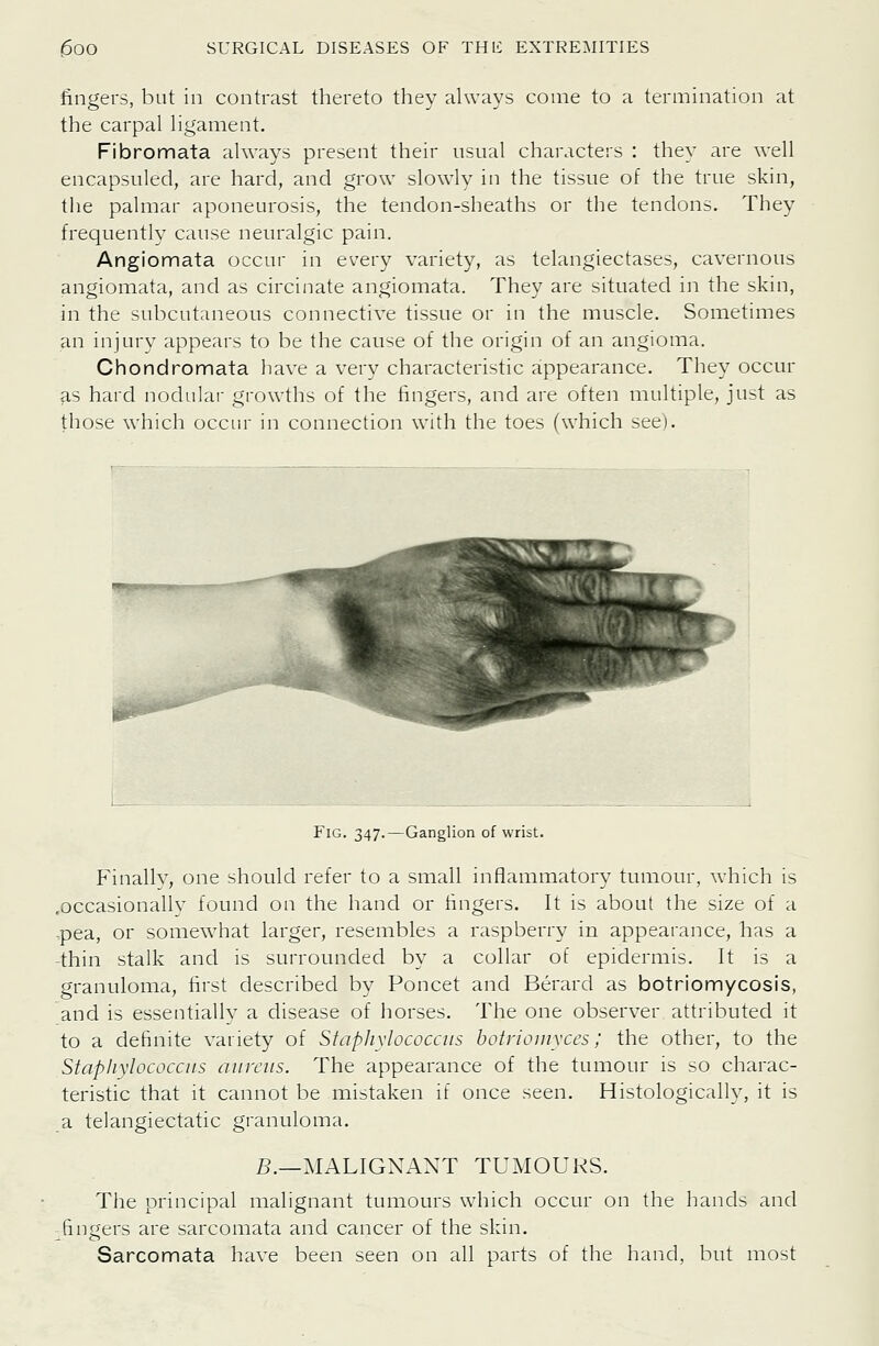 fingers, but in contrast thereto they always come to a termination at the carpal ligament. Fibromata always present their usual characters : they are well encapsuled, are hard, and grow slowly in the tissue of the true skin, the palmar aponeurosis, the tendon-sheaths or the tendons. They frequently cause neuralgic pain. Angiomata occur in every variety, as telangiectases, cavernous angiomata, and as circinate angiomata. They are situated in the skin, in the subcutaneous connective tissue or in the muscle. Sometimes an injury appears to be the cause of the origin of an angioma. Chondromata have a very characteristic appearance. They occur as hard nodulai- growths of the fingers, and are often multiple, just as those which occur in connection with the toes (which see). Fig. 347.—Ganglion of wrist. Finally, one should refer to a small inflammatory tumour, which is .occasionally found on the hand or fingers. It is about the size of a -pea, or somewhat larger, resembles a raspberry in appearance, has a -thin stalk and is surrounded by a collar of epidermis. It is a granuloma, first described by Poncet and Berard as botriomycosis, and is essentially a disease of horses. The one observer attributed it to a definite variety of Staphylococcus botriouiyces; the other, to the Stapliylococcns aureus. The appearance of the tumour is so charac- teristic that it cannot be mistaken if once seen. Histologically, it is a telangiectatic granuloma. B.—MALIGNANT TUMOURS. The principal malignant tumours which occur on the hands and fingers are sarcomata and cancer of the skin. Sarcomata have been seen on all parts of the hand, but most