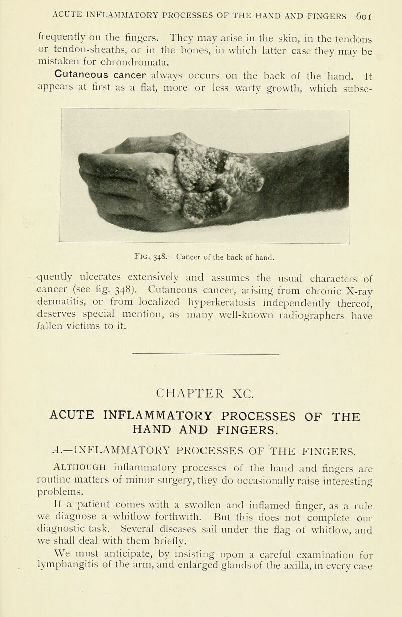 frequently on the fingers. They may arise in the skin, in the tendons or tendon-sheaths, or in the bones, in which latter case they may be mistaken for chrondromata. Cutaneous cancer always occurs on the back of the hand. It appears at first as a flat, more or less warty growth, which subse- FlG. 348.—Cancer of the back of hand. quently ulcerates extensively and assumes the usual characters of cancer (see fig. 348). Cutaneous cancer, arising from chronic X-ray dermatitis, or from localized hyperkeratosis independently thereof, deserves special mention, as many well-known radiographers have fallen victims to it. CHAPTER XC. ACUTE INFLAMMATORY PROCESSES OF THE HAND AND FINGERS. .4.—INFLAMMATORY PROCESSES OF THE FIXGERS. Although inflammatory processes of the hand and fingers are routine matters of minor surgery, they do occasionally raise interesting problems. If a patient comes with a swollen and inflamed finger, as a rule we diagnose a whitlow forthwith. But this does not complete our diagnostic task. Several diseases sail under the flag of whitlow, and we shall deal with them briefly. We must anticipate, by insisting upon a careful examination for lymphangitis of the arm, and enlarged glands of the axilla, in every case