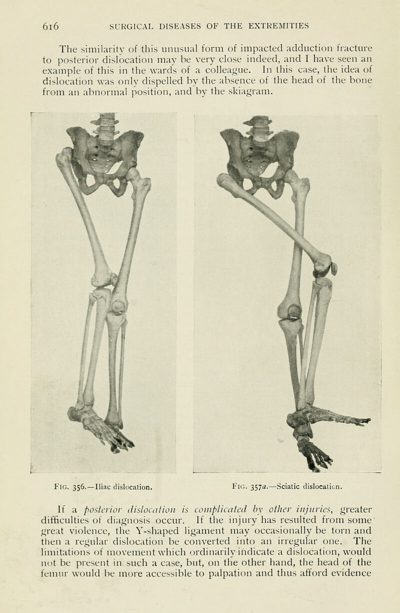 The similarity of this unusual form of impacted adduction fracture to posterior dislocation may be very close indeed, and I have seen an example of this in the wards of a colleague. In this case, the idea of dislocation was only dispelled by the absence of the head of the bone from an abnormal position, and by the skiagram. )^ L Fig. 356.—Iliac dislocation. Fig. 357a.—Sciatic dislocation. If a posterior dislocation is coniplicated by other injuries, greater difficulties of diagnosis occur. If the injury has resulted from some great violence, the Y-shaped ligament may occasionally be torn and then a regular dislocation be converted into an irregular one. The limitations of movement which ordinarily iiidicate a dislocation, would not be present in such a case, but, on the other hand, the head of the femur would be more accessible to palpation and thus afford evidence