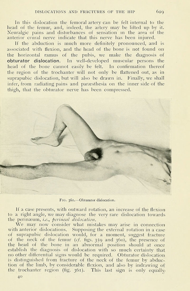 In this dislocation the femoral artery can be felt internal to the head of the femur, and, indeed, the artery may be lifted up by it. Neuralgic pains and disturbances of sensation ui the area of the anterior crural nerve indicate that this nerve has been injured. If the abduction is much more definitely pronounced, and is associated with flexion, and the head of the bone is not found on the horizontal ramus of the pubis, we make the diagnosis of obturator dislocation. In well-developed muscular persons the head of the bone cannot easily be felt. In confirmation thereof the region of the trochanter will not only be flattened out, as in suprapubic dislocation, but will also be drawn in. Finally, we shall infer, from radiating pains and parassthesia on the inner side of the thigh, that the obturator nerve has been compressed. S-J^ Fig. ^61.—Obturator dislocation. If a case presents, with outward rotation, an increase of the flexion to a right angle, we may diagnose the very rare dislocation towards the perinaeum, i.e., perineal dislocation. We may now consider what mistakes may arise in connection with anterior dislocations. Supposing the external rotation in a case of suprapubic dislocation would, for a moment, suggest fracture of the neck of the femur [cf. figs. 359 and 360), the presence of the head of the bone in an abnormal position should at once establish the diagnosis of dislocation with so much certainty that no other differential signs would be required. Obturator dislocation is distinguished from fracture of the neck of the femur by abduc-. tion of the limb, by considerable flexion, and also by indrawing of the trochanter region (fig. 361). This last sign is only equally. 40