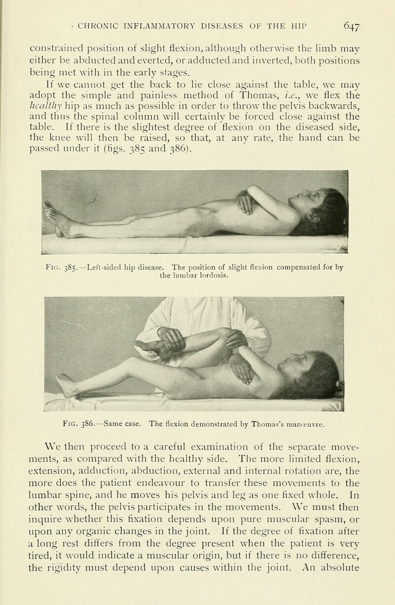 constrained position of slight flexion, although otherwise the limb may either be abducted and everted, or adducted and inverted, both positions being met with in the early stages. If we cannot get the back to lie close against the table, we may adopt the simple and painless method of Thomas, i.e., we flex the healthy hip as much as possible in order to throw the pelvis backwards,, and thus the spinal column will certainly be forced close against the table. If there is the slightest degree of flexion on the diseased side,, the knee will then be raised, so that, at any rate, the hand can be passed under it (figs. 385 and 386). Fig. 385.—Lefl-sided hip disease. The position of slight flexion compensated for by the lumbar lordosis. Fig. 386.—Same case. The flexion demonstrated by Thomas's rnanceuvre. We then proceed to a careful examination of the separate move- ments, as compared with the healthy side. The more limited flexion,, extension, adduction, abduction, external and internal rotation are, the more does the patient endeavour to transfer these movements to the lumbar spine, and he moves his pelvis and leg as one fixed whole. In other words, the pelvis participates in the movements. We must then inquire whether this fixation depends upon pure muscular spasm, or upon any organic changes in the joint. If the degree of fixation after a long rest dift'ers from the degree present when the patient is very tired, it would indicate a muscular origin, but if there is no difference, the rigidity must depend upon causes within the joint. An absolute