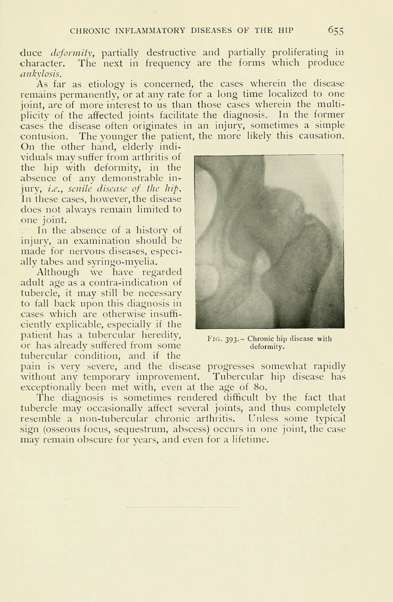 cluce dcfonnitv, partially destructive and partially proliferating in character. The next in h-equency are the forms which produce ankylosis. As far as etiology is concerned, the cases wherein the disease remains permanently, or at any rate for a long time localized to one joint, are of more interest to us than those cases wherein the multi- plicity of the affected joints facilitate the diagnosis. In the former cases the disease often originates in an injury, sometimes a simple contusion. The younger the patient, the more likely this causation. On the other hand, elderly indi- viduals may suffer from arthritis of the hip with deformity, in the absence of any demonstrable in- jury, i.e., senile disease of the hip. In these cases, however, the disease does not always remain limited to one joint. In the absence of a history of injury, an examination should be made for nervous diseases, especi- ally tabes and syringo-myelia. Although we have regarded adult age as a contra-indication of tubercle, it may still be necessary to fall back upon this diagnosis in cases which are otherwise insuffi- ciently explicable, especially if the patient has a tubercular heredity, or has already suffered from some tubercular condition, and if the pain is very severe, and the disease progresses somewhat rapidly without any temporary improvement. Tubercular hip disease has exceptionally been met with, even at the age of 80. The diagnosis is sometimes rendered difficult by the fact that tubercle may occasionally affect several joints, and thus completely resemble a non-tubercular chronic arthritis. Unless some typical sign (osseous focus, sequestrum, abscess) occurs in one joint, the case may remain obscure for years, and even for a lifetime. Fig. 393-- Chronic hip disease with deformity.