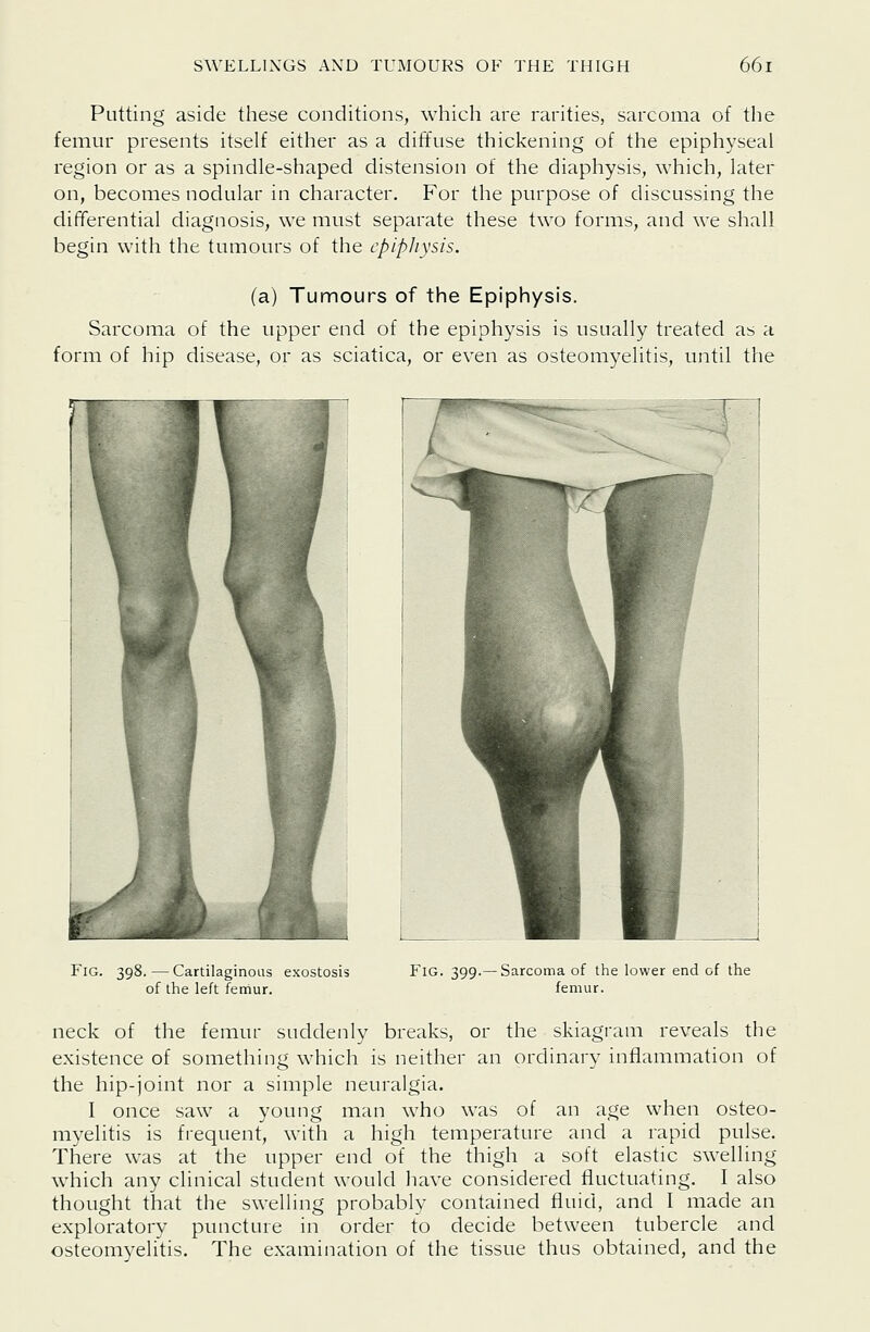 Putting aside these conditions, which are rarities, sarcoma of the femur presents itself either as a diffuse thickening of the epiphyseal region or as a spindle-shaped distension of the diaphysis, which, later on, becomes nodular in character. For the purpose of discussing the differential diagnosis, we must separate these two forms, and we shall begin with the tumours of the epipJiysis. (a) Tumours of the Epiphysis. Sarcoma of the upper end of the epiphysis is usually treated as a form of hip disease, or as sciatica, or even as osteomyelitis, until the Fig. 398.—Cartilaginous exostosis of the left fetiiur. Fig. 399.— Sarcoma of the lower end of the femur. neck of the femur suddenly breaks, or the skiagram reveals the existence of something which is neither an ordinary inflammation of the hip-joint nor a simple neuralgia. I once saw a young man who was of an age when osteo- myelitis is frequent, with a high temperature and a rapid pulse. There was at the upper end of the thigh a soft elastic swelling which any clinical student would have considered fluctuating. I also thought that the swelling probably contained fluid, and I made an exploratory puncture in order to decide between tubercle and osteomyelitis. The examination of the tissue thus obtained, and the