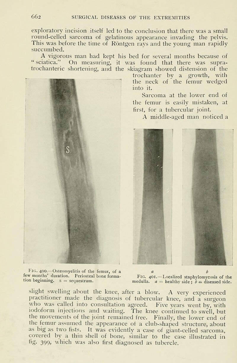 exploratory incision itself led to the conclusion that there was a small round-celled sarcoma of gelatinous appearance invading the pelvis. This was before the time of Rontgen rays and the young man rapidly succumbed. A vigorous man had kept his bed for several months because of  sciatica. On measuring, it was found that there was supra- trochanteric shortening, and the skiagram showed distension of the trochanter by a : the neck of the [ into it. ' Sarcoma at the lower end of the femur is easily mistaken, at first, for a tubercular joint. A middle-aged man noticed a growth, with femur wedged L. Fig. 400.—Osteomyelitis of the femur, of a few months' duration. Periosteal bone forma- tion beginning, s = sequestrum. Fig. 401.—Localized staphylomycosis of the medulla, a = healthy side ; d = diseased side. slight swelling about the knee, after a blow. A very experienced practitioner made the diagnosis of tubercular knee, and a surgeon who was called into consultation agreed. Five years went by, with iodoform injections and waiting. The knee continued to swell, but the movements of the joint remained free. Finally, the lower end of the femur assumed the appearance of a club-shaped structure, about as big as two fists. It was evidently a case of giant-celled sarcoma, covered by a thin shell of bone, similar to the case illustrated in fig- 399; ^vhich was also first diagnosed as tubercle.