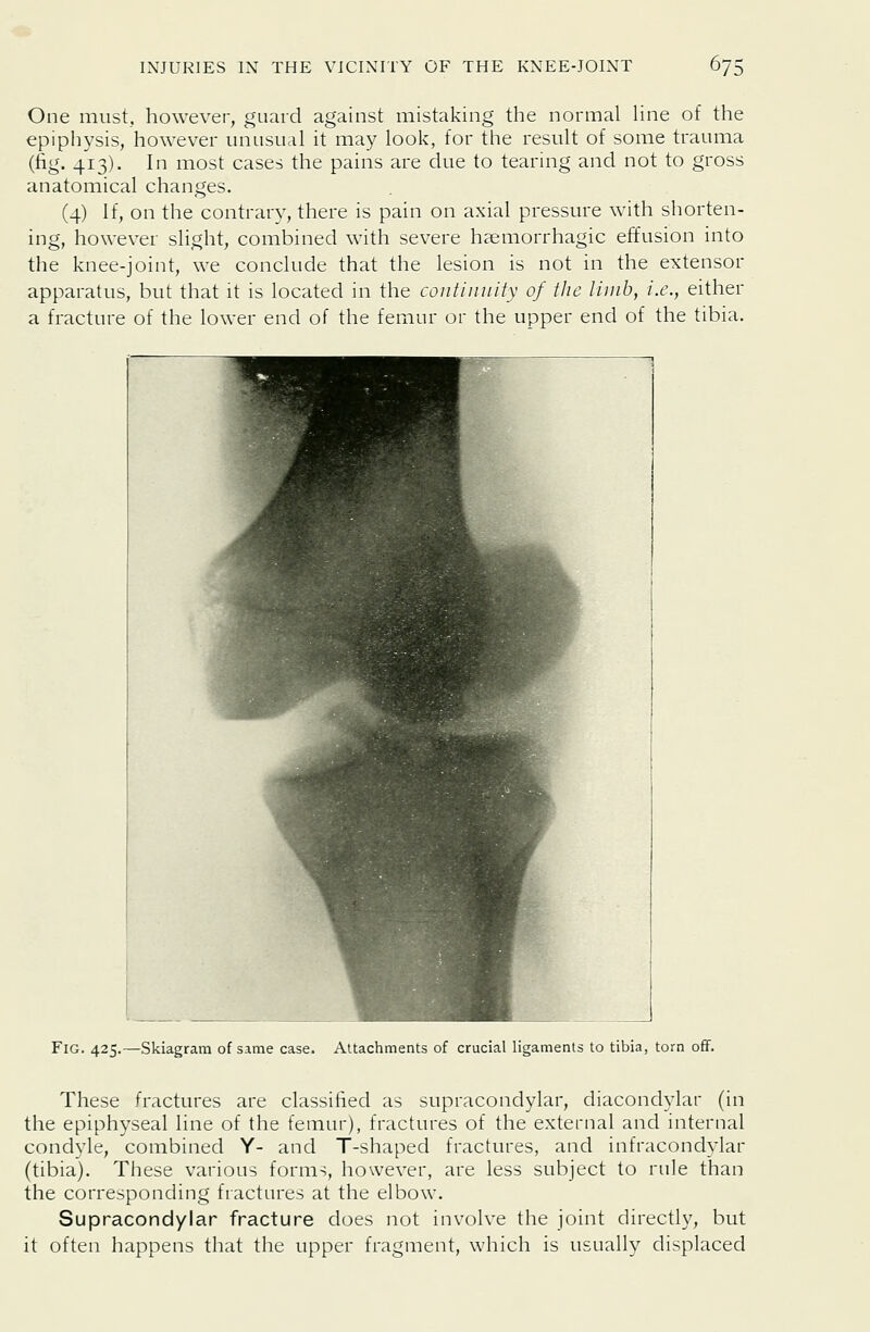 One must, however, guard against mistaking the normal hne of the epiphysis, however unusual it may look, for the result of some trauma (fig. 413). In most cases the pains are due to tearing and not to gross anatomical changes. (4) If, on the contrary, there is pain on axial pressure with shorten- ing, however slight, combined with severe haemorrhagic effusion into the knee-joint, we conclude that the lesion is not in the extensor apparatus, but that it is located in the continuity of the limb, i.e., either a fracture of the lower end of the femur or the upper end of the tibia. Fig. 425.—Skiagram of same case. Attachments of crucial ligaments to tibia, torn off. These fractures are classified as supracondylar, diacondylar (in the epiphyseal line of the femur), fractures of the external and internal condyle, combined Y- and T-shaped fractures, and infracondylar (tibia). These various forms, however, are less subject to rule than the corresponding fractures at the elbow. Supracondylar fracture does not involve the joint directly, but it often happens that the upper fragment, which is usually displaced