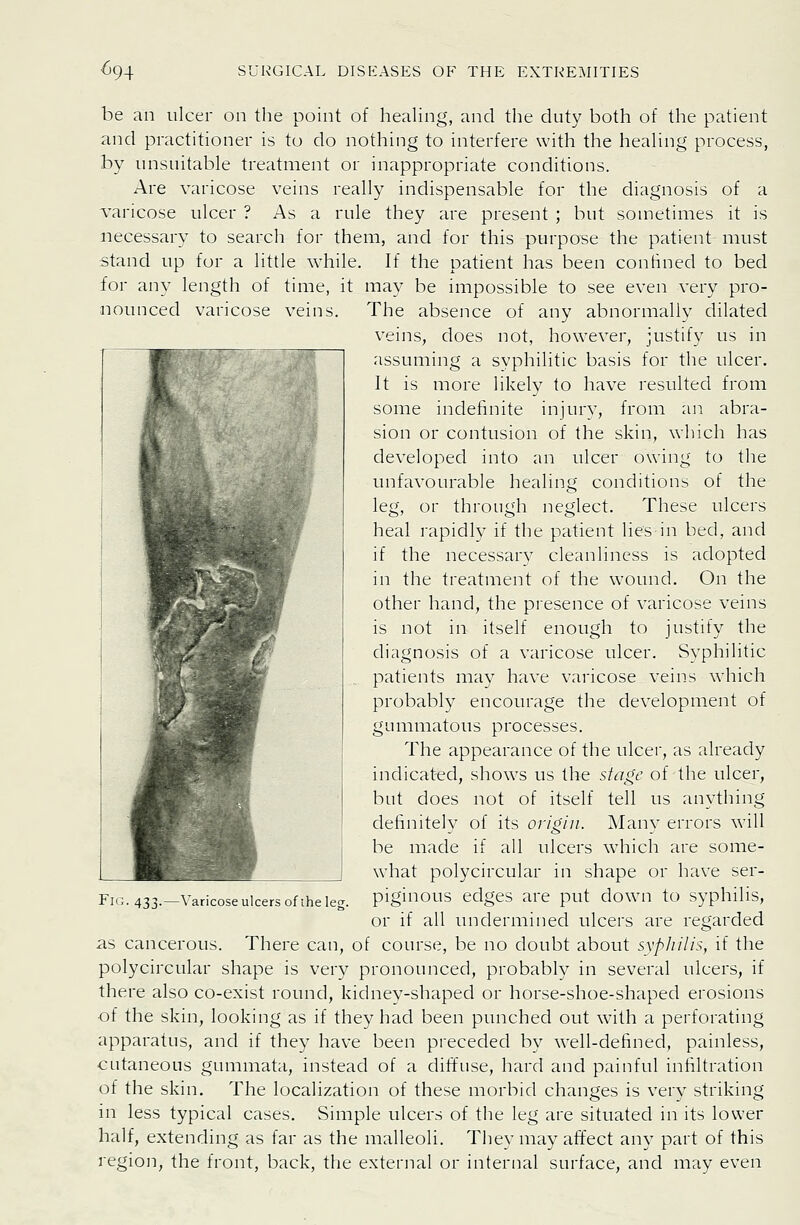 be an ulcer on the point of healing, and the duty both of the patient and practitioner is to do nothing to interfere with the heahng process, by unsuitable treatment or inappropriate conditions. Are varicose veins really indispensable for the diagnosis of a varicose ulcer ? As a rule they are present ; but sometimes it is necessary to search for them, and for this purpose the patient must stand up for a little while. If the patient has been confined to bed for any length of time, it may be impossible to see even very pro- nounced varicose veins. The absence of any abnormally dilated veins, does not, however, justify us in assuming a syphilitic basis for the ulcer. It is more likely to have resulted from some indefinite injury, from an abra- sion or contusion of the skin, which has developed into an ulcer owing to the unfavourable healing conditions of the leg, or through neglect. These ulcers heal rapidlv if the patient lies in bed, and if the necessarv cleanliness is adopted in the treatment of the wound. On the other hand, the presence of varicose veins is not in itself enough to justify the diagnosis of a varicose ulcer. Syphilitic patients may have varicose veins which probably encourage the development of gummatous processes. The appearance of the ulcer, as already indicated, shows us the stage of the ulcer, but does not of itself tell us anything definitely of its origin. Many errors will be made if all ulcers which are some- what polycircular in shape or have ser- piginous edges are put down to syphilis, or if all undermined ulcers are regarded as cancerous. There can, of course, be no doubt about syphilis, if the polycircular shape is very pronounced, probably in several ulcers, if there also co-exist round, kidney-shaped or horse-shoe-shaped erosions of the skin, looking as if they had been punched out with a perforating apparatus, and if they have been preceded by well-defined, painless, cutaneous gummata, instead of a diffuse, hard and painful infiltration of the skin. The localization of these morbid changes is very striking in less typical cases. Simple ulcers of the leg are situated in its lower half, extending as far as the malleoli. They may affect any part of this region, the front, back, the external or internal surface, and may even Fig. 433.—Varicose ulcers of ihe leg.