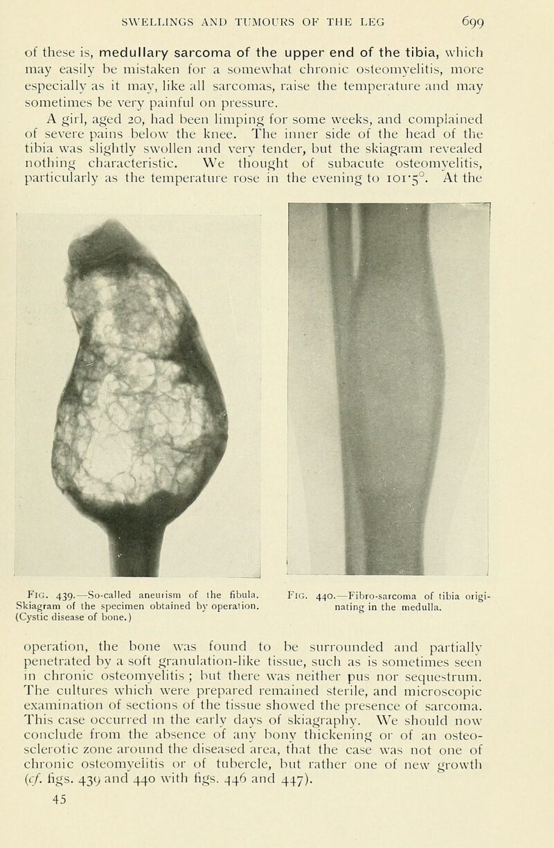 of these is, medullary sarcoma of the upper end of the tibia, which may easily be mistaken for a somewhat chronic osteomyelitis, more especially as it may, like all sarcomas, raise the temperature and may sometimes be very painful on pressure. A girl, aged 20, had been limping for some weeks, and complained of severe pains below the knee. The inner side of the head of the tibia was sliglitly swollen and very tender, but the skiagram revealed nothing characteristic. We thought of subacute osteomyelitis, particularly as the temperature rose in the evening to 101*5°. ^^ the Fig. 439.—So-called aneurism of the fibula. Skiagram of the specimen obtained by operation. (Cystic disease of bone.) Fig. 440.—Fibro-sarcoma of tibia origi- nating in the medulla. operation, the bone was found to be surrounded and partially penetrated by a soft granulation-like tissue, such as is sometimes seen in chronic osteomyelitis ; but there was neither pus nor sequestrum. The cultures which were prepared remained sterile, and microscopic examination of sections of the tissue showed the presence of sarcoma. This case occurred m the early days of skiagraphy. We should now conclude from the absence of any bony thickening or of an osteo- sclerotic zone around the diseased area, that the case was not one of chronic osteomyelitis or of tubercle, but rather one of new growth {cf. figs. 439 and 440 with figs. 446 and 447). 45