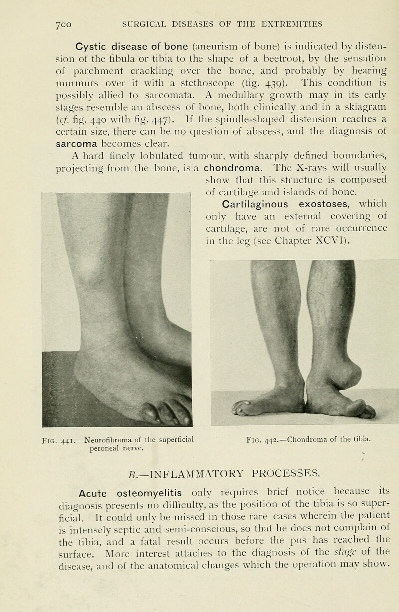 7CO Cystic disease of bone (aneurism of bone) is indicated by disten- sion of the fibula or tibia to the sliape of a beetroot, by the sensation of parchment crackhng over the bone, and probably by hearing murmurs over it with a stethoscope (fig. 439). This condition is possibly allied to sarcomata. A medullary growth may in its early stages resemble an abscess of bone, both clinically and in a skiagram {cf. fig. 440 with fig. 447). If the spindle-shaped distension reaches a certain size, there can be no question of abscess, and the diagnosis of sarcoma becomes clear. A hard finely lobulated tum'mr, with sharply defined boundaries, projecting from the bone, is a chondroma. The X-rays will usually show that this structure is composed of cartilage and islands of bone. Cartilaginous exostoses, which onlv have an external covering of cartilage, are not of rare occurrence in the leg (see Chapter XCVI). Fig. 441.—Neurofibroma of the superficial peroneal nerve. Fig. 442.—Chondroma of the tibia. B.—INFLAMMATORY PROCESSES. Acute osteomyelitis only requires brief notice because its diagnosis presents no difficulty, as the position of the tibia is so super- ficial. It could only be missed in those rare cases wherein the patient is intensely septic and semi-conscious, so that he does not complain of the tibia, and a fatal result occurs before the pus has reached the surface. More interest attaches to the diagnosis of the stage of the disease, and of the anatomical changes which the operation may show.