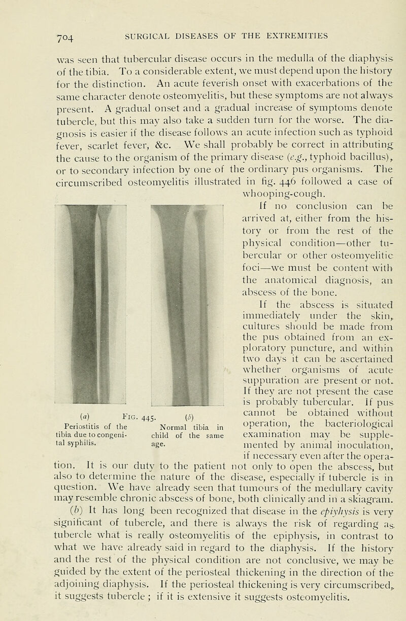 was seen that tubercular disease occurs in the medulla of the diaphysis of the tibia. To a considerable extent, we must depend upon the history for the distinction. An acute feverish onset with exacerbations of the same character denote osteomyelitis, but these symptoms are not always present. A gradual onset and a gradual increase of symptoms denote tubercle, but this may also take a sudden turn for the worse. The dia- gnosis is easier if the disease follows an acute infection such as typhoid fever, scarlet fever, &c. We shall probably be correct in attributing the cause to the organism of the primary disease (e.g., typhoid bacillus),, or to secondary infection by one of the ordinary pus organisms. The circumscribed osteomyelitis illustrated in fig. 446 followed a case of whooping-cough. If no conclusion can be arrived at, either from the his- tory or from the rest of the physical condition—other tu- bercular or other osteomyelitic foci—we must be content with the anatomical diagnosis, an abscess of the bone. If the abscess is situated immediately under the skin,, cultures should be made from the pus obtained from an ex- ploratory puncture, and within two days it can be ascertained whether organisms of acute suppuration are present or not. If they are not present the case is probably tubercular. If pus cannot be obtained without operation, the bacteriological examination may be supple- mented by annual inoculation, if necessary even after the opera- tion. It is our duty to the patient not only to open the abscess, but also to determine the nature of the disease, especially if tubercle is in question. We have already seen that tumours of the medullary cavity may resemble chronic abscess of bone, both clinically and in a skiagram. (b) It has long been recognized that disease in the epiyhysis is very significant of tubercle, and there is always the risk of regarding ag. tubercle what is really osteomyelitis of the epiphysis, in contrast to what we have already said in regard to the diaphysis. If the history and the rest of the physical condition are not conclusive, we may be guided by the extent of the periosteal thickening in the direction of the adjoining diaphysis. If the periosteal thickening is very circumscribed,, it suggests tubercle ; if it is extensive it suggests osteomyelitis. (a) Fig. 445. {d) Periostitis of the Normal tibia in tibia due to congeni- child of the same tal syphilis. age.