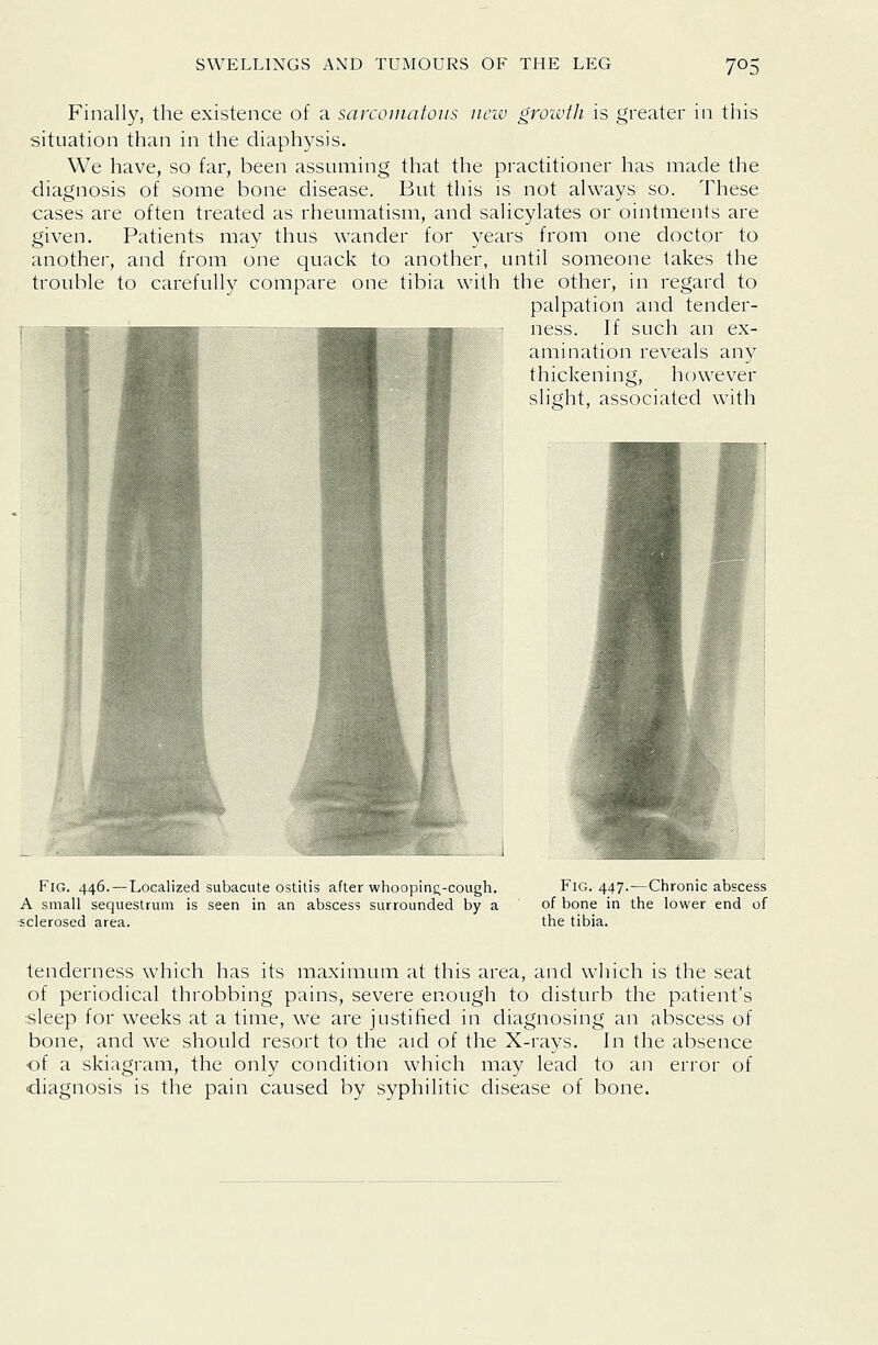 Finally, the existence of a sarcouiatoiis new growth is greater in this situation than in the diaphysis. We have, so far, been assuming that the practitioner has made the diagnosis of some bone disease. But this is not always so. These cases are often treated as rheumatism, and salicylates or ointments are given. Patients may thus wander for years from one doctor to another, and from one quack to another, until someone lakes the trouble to carefully compare one tibia with the other, in regard to palpation and tender- ness. If such an ex- amination reveals any thickening, however slight, associated with Fig. 446.—Localized subacute ostitis after whoopinf;-cough. A small sequestrum is seen in an abscess surrounded by a sclerosed area. Fig. 447.—Chronic abscess of bone in the lower end of the tibia. tenderness which has its maximum at this area, and which is the seat of periodical throbbing pains, severe enough to disturb the patient's sleep for weeks at a time, we are justified in diagnosing an abscess of bone, and we should resort to the aid of the X-rays. In the absence of a skiagram, the only condition which may lead to an error of diagnosis is the pain caused by syphilitic disease of bone.