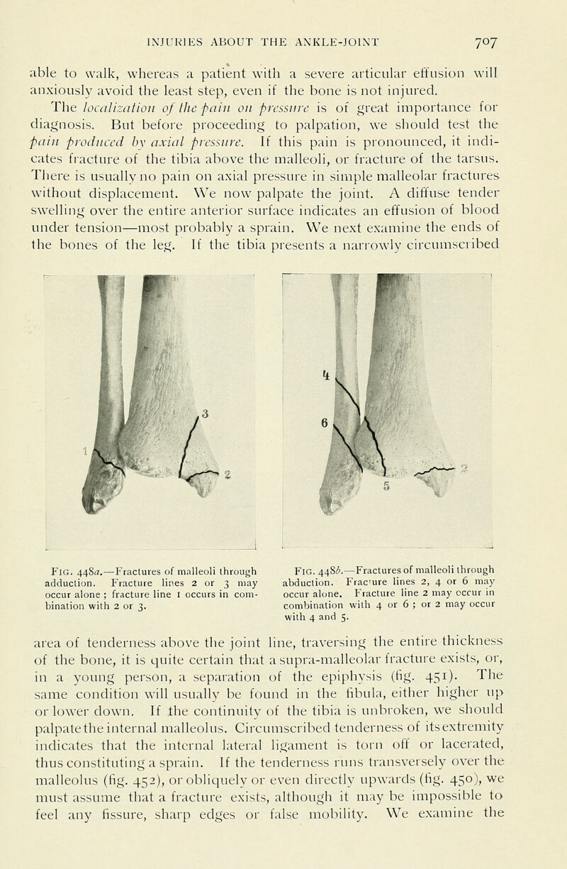 able to walk, whereas a patient with a severe articular effusion will anxiously avoid the least step, even if the bone is not injured. The localization of the pain on pressure is of great importance for diagnosis. But before proceeding to palpation, we should test the pain produced by axial pressure. If this pain is pronounced, it indi- cates fracture of the tibia above the malleoli, or fracture of the tarsus. There is usually no pain on axial pressure in simple malleolar fractures without displacement. We now palpate the joint. A diffuse tender sw^elling over the entire anterior surface indicates an effusion of blood under tension—most probably a sprain. We next examine the ends of the bones of the leg. If the tibia presents a narrowly circumscribed J Fig. 448^.—Fractures of malleoli through adduction. Fracture lines 2 or 3 may occur alone ; fracture line i occurs in com- bination with 2 or 3. Fig. 4481^.—Fractures of malleoli through abduction. Frac'ure lines 2, 4 or 6 may occur alone. Fracture line 2 may occur in combination with 4 or 6 ; or 2 may occur with 4 and 5. area of tenderness above the joint line, traversing the entire thickness of the bone, it is quite certain that a supra-malleolar fracture exists, or, in a young person, a separation of the epiphysis (fig. 45i)- The same condition will usually be found in the fibula, either higher up or low^er down. If the continuity of the tibia is unbroken, we should palpate the internal malleolus. Circumscribed tenderness of itsextremity indicates that the internal lateral ligament is torn off or lacerated, thus constituting a sprain. If the tenderness runs transversely over the malleolus (fig. 452), or obliquely or even directly upwards (fig. 450), we must assume that a fracture exists, although it may be impossible to feel any fissure, sharp edges or false mobility. We examine the